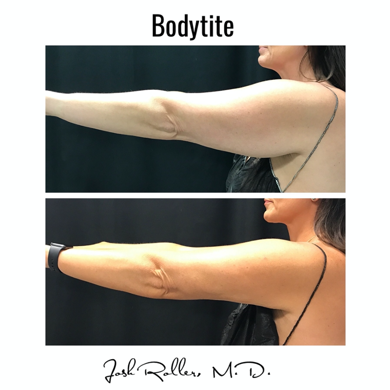 BodyTite Before & After Gallery - Patient 12808 - Image 3