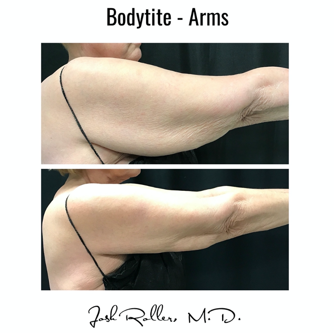 BodyTite Before & After Gallery - Patient 12805 - Image 1
