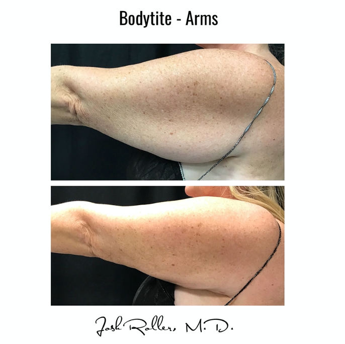 BodyTite Before & After Gallery - Patient 12800 - Image 1