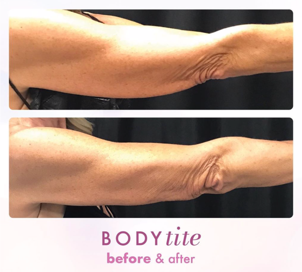BodyTite Before & After Gallery - Patient 12793 - Image 1