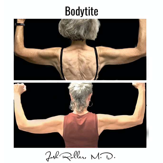 BodyTite Before & After Gallery - Patient 12791 - Image 1