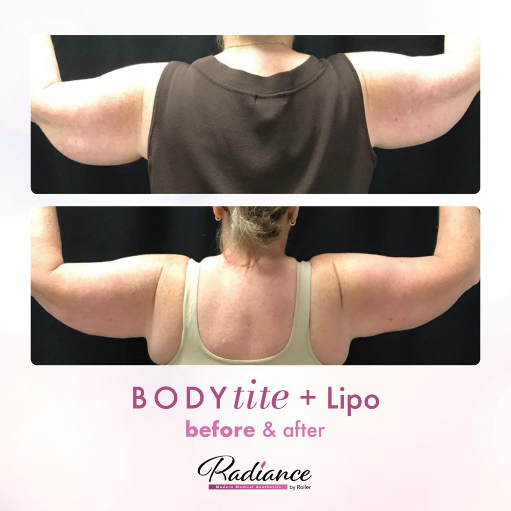 BodyTite Before & After Gallery - Patient 12786 - Image 1