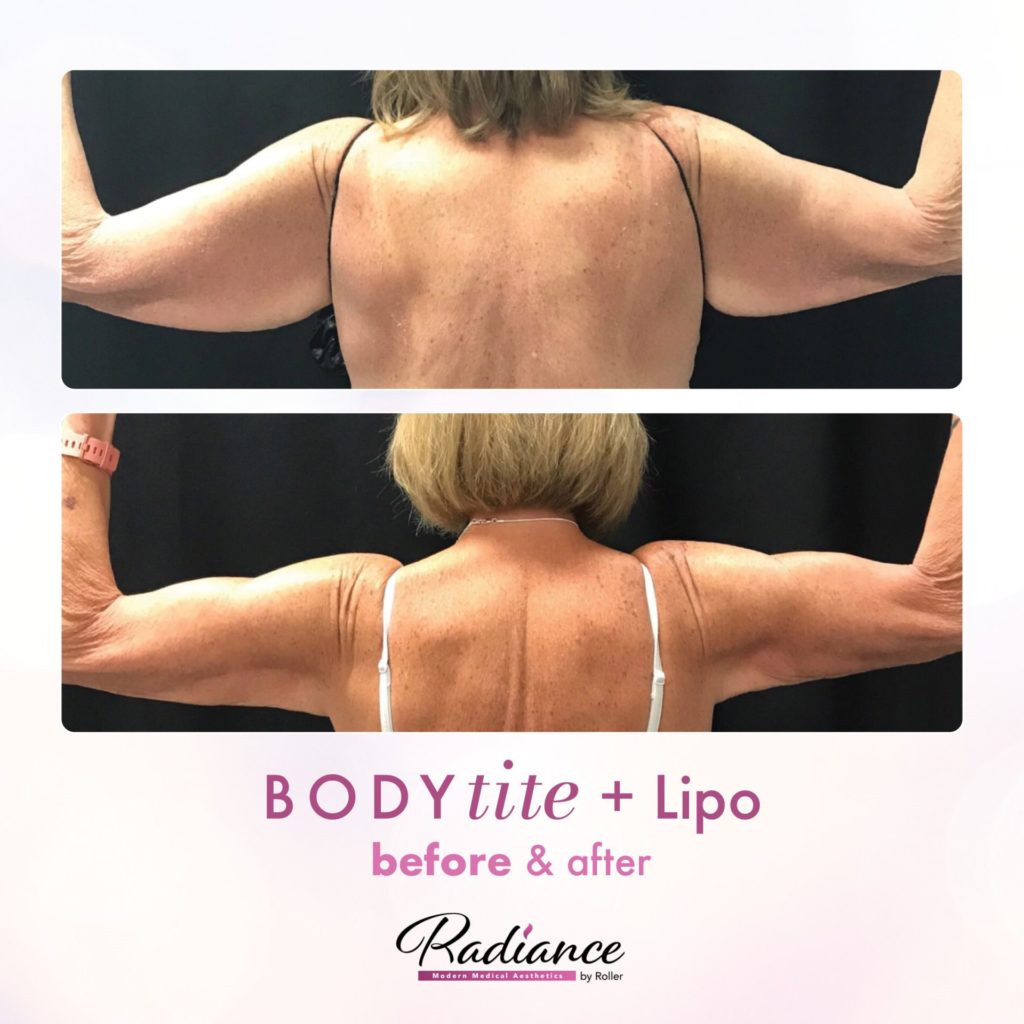 BodyTite Before & After Gallery - Patient 12784 - Image 1