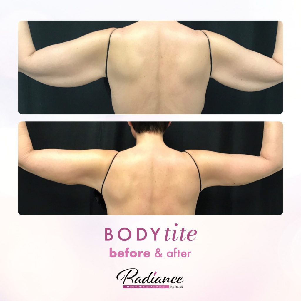 BodyTite Before & After Gallery - Patient 12780 - Image 1