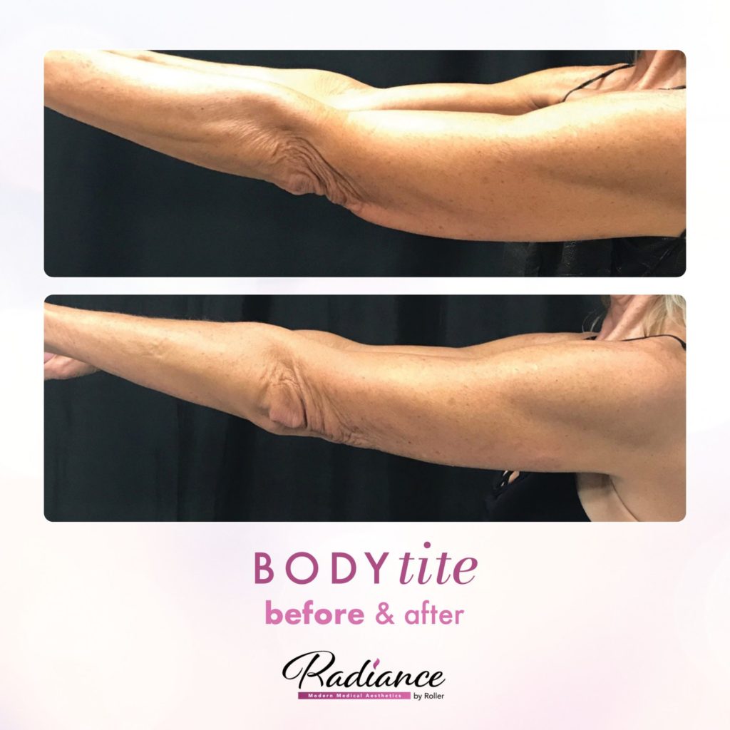 BodyTite Before & After Gallery - Patient 12777 - Image 2