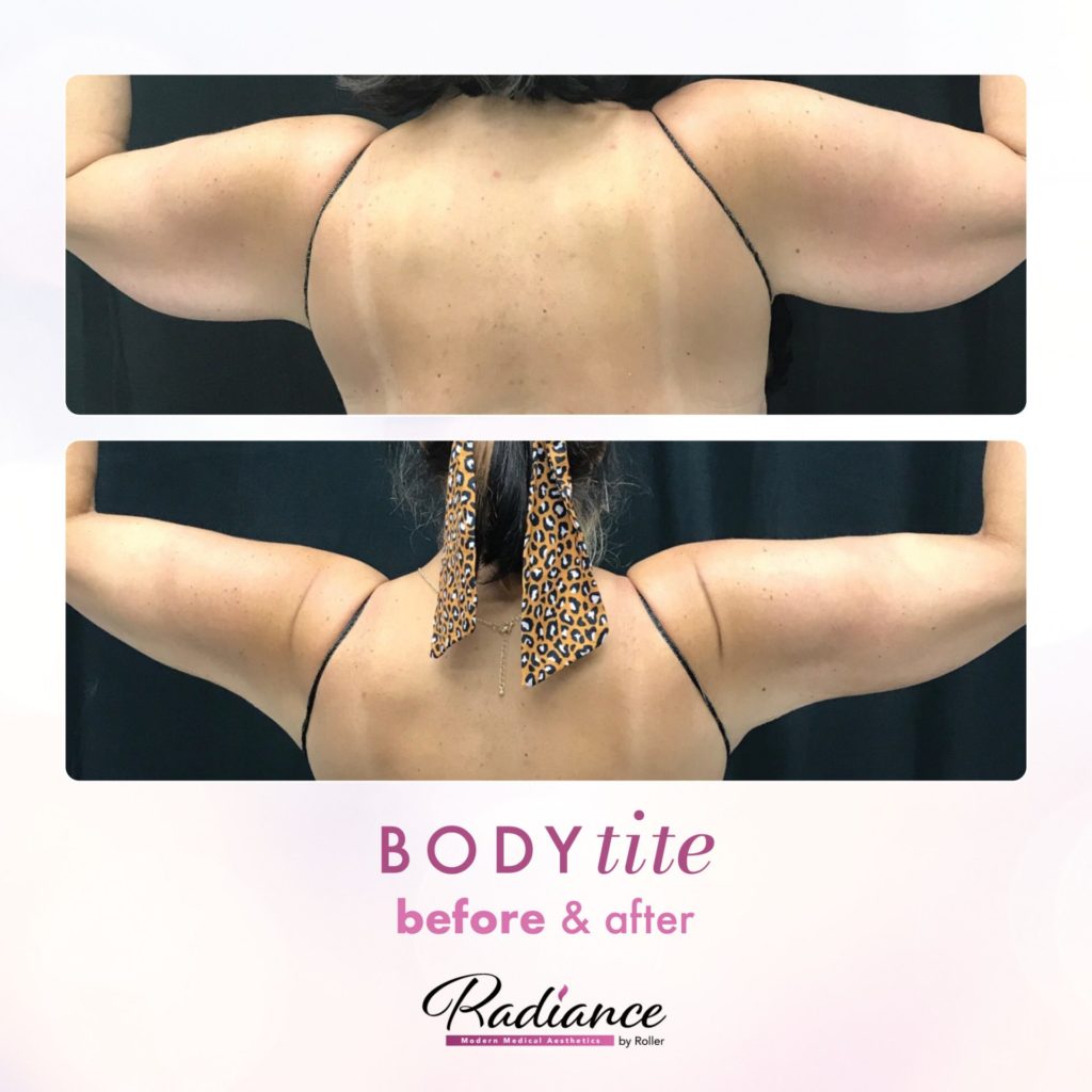 BodyTite Before & After Gallery - Patient 12774 - Image 1