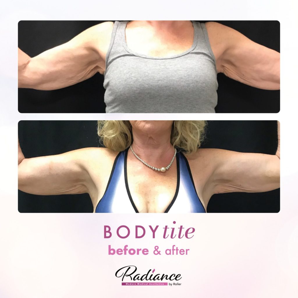 BodyTite Before & After Gallery - Patient 12772 - Image 1