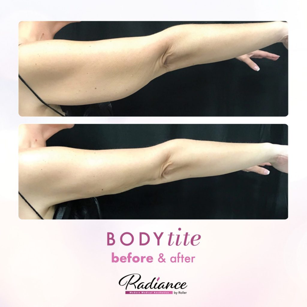 BodyTite Before & After Gallery - Patient 12769 - Image 2
