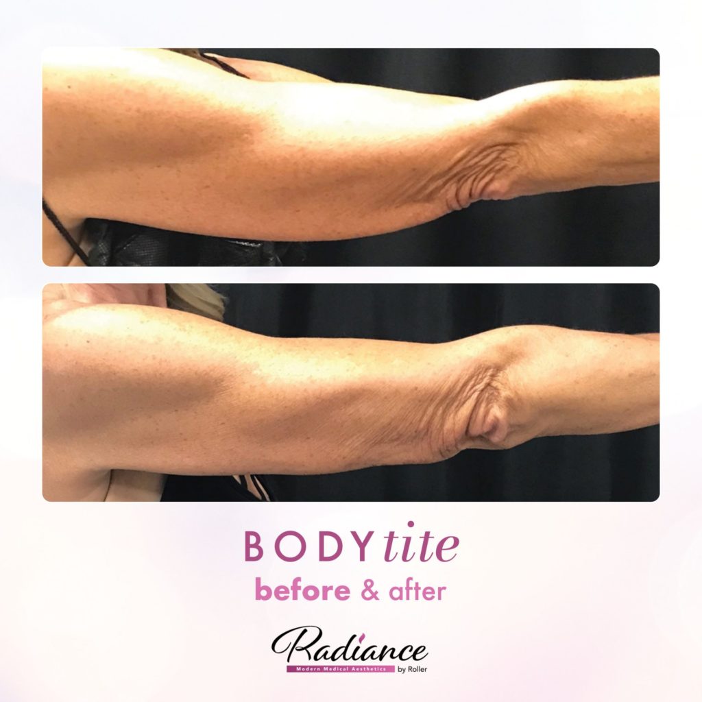 BodyTite Before & After Gallery - Patient 12764 - Image 2