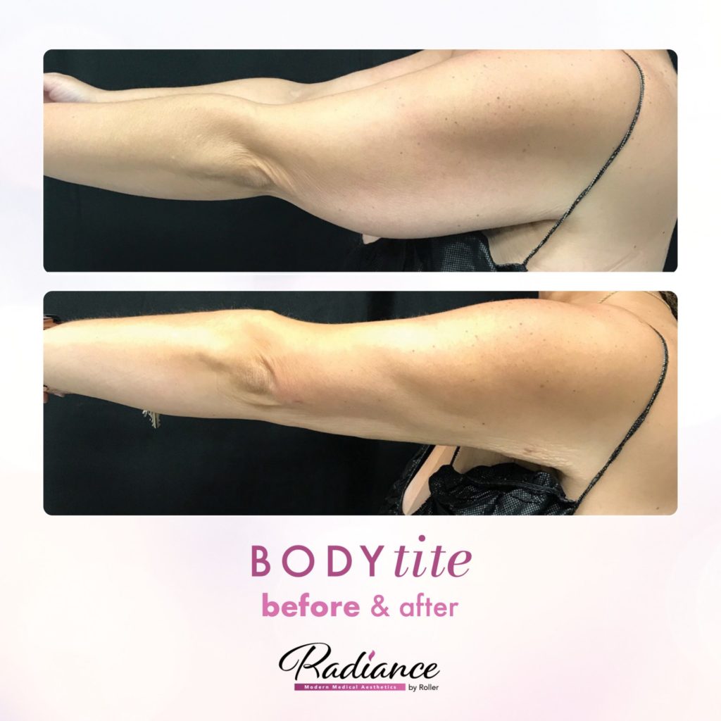BodyTite Before & After Gallery - Patient 12762 - Image 1