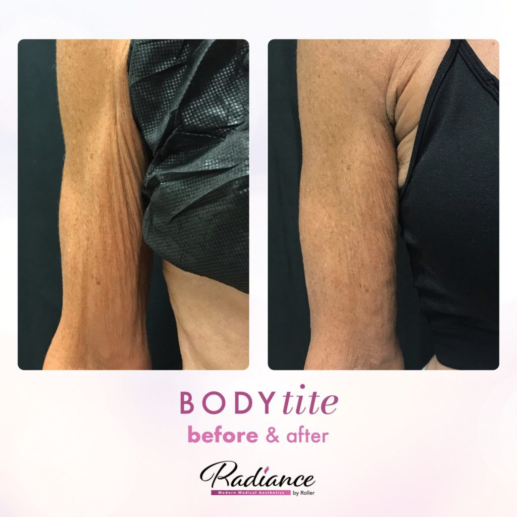 BodyTite Before & After Gallery - Patient 12757 - Image 1
