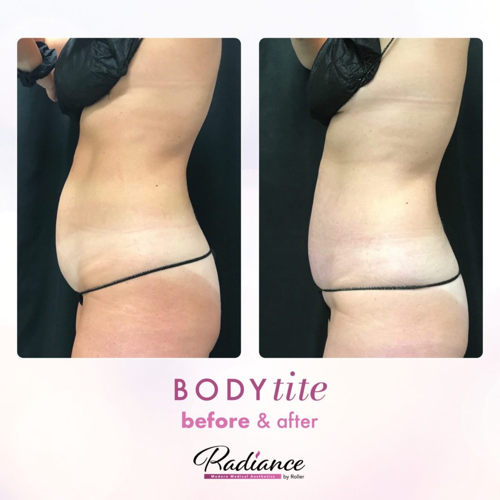 BodyTite Before & After Gallery - Patient 12754 - Image 1
