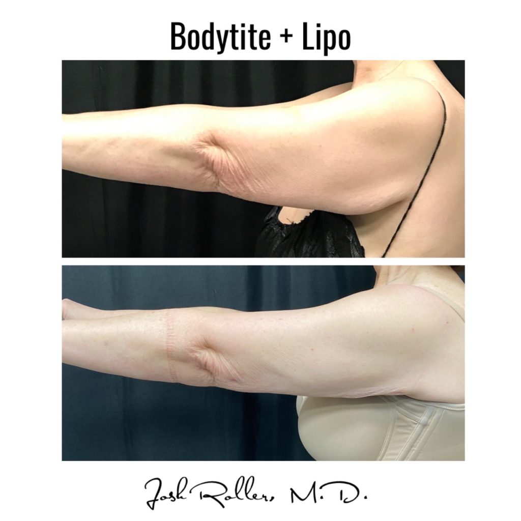 BodyTite Before & After Gallery - Patient 12743 - Image 1