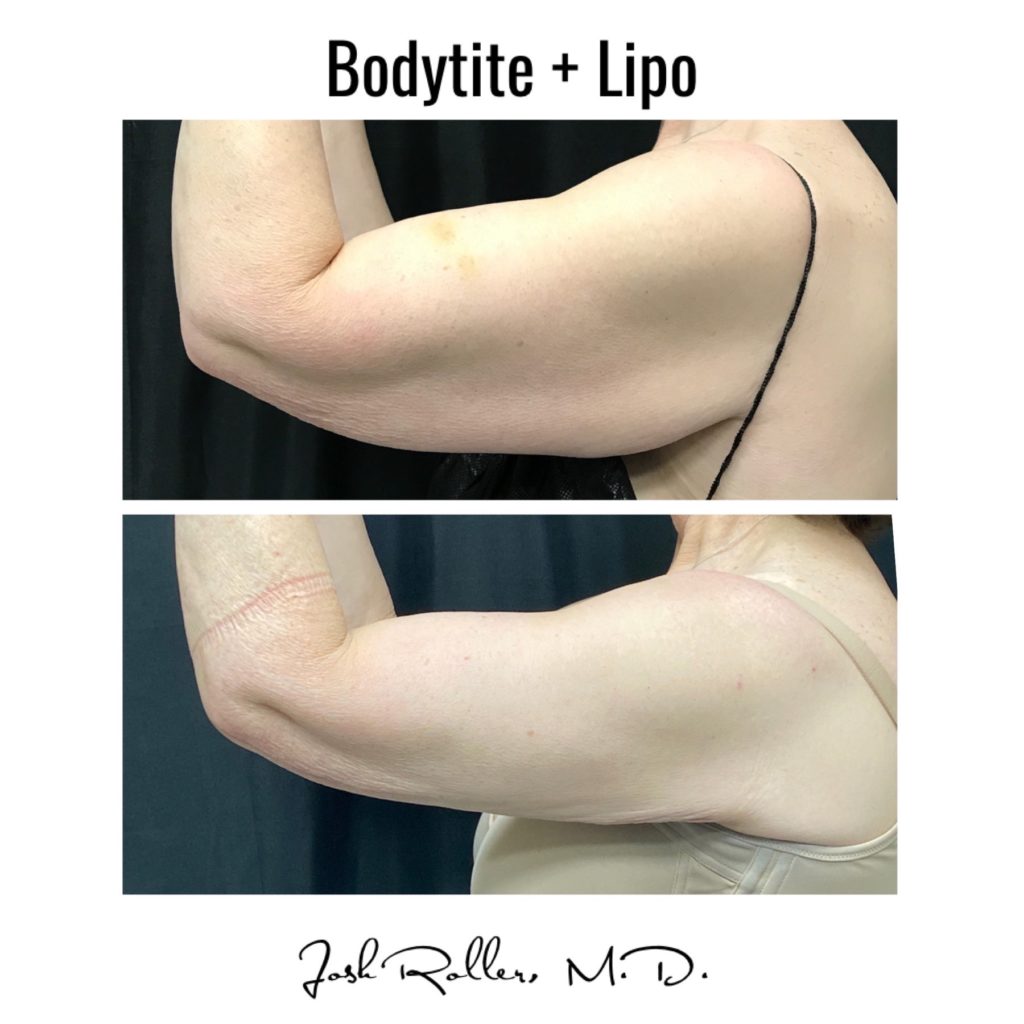 BodyTite Before & After Gallery - Patient 12743 - Image 2