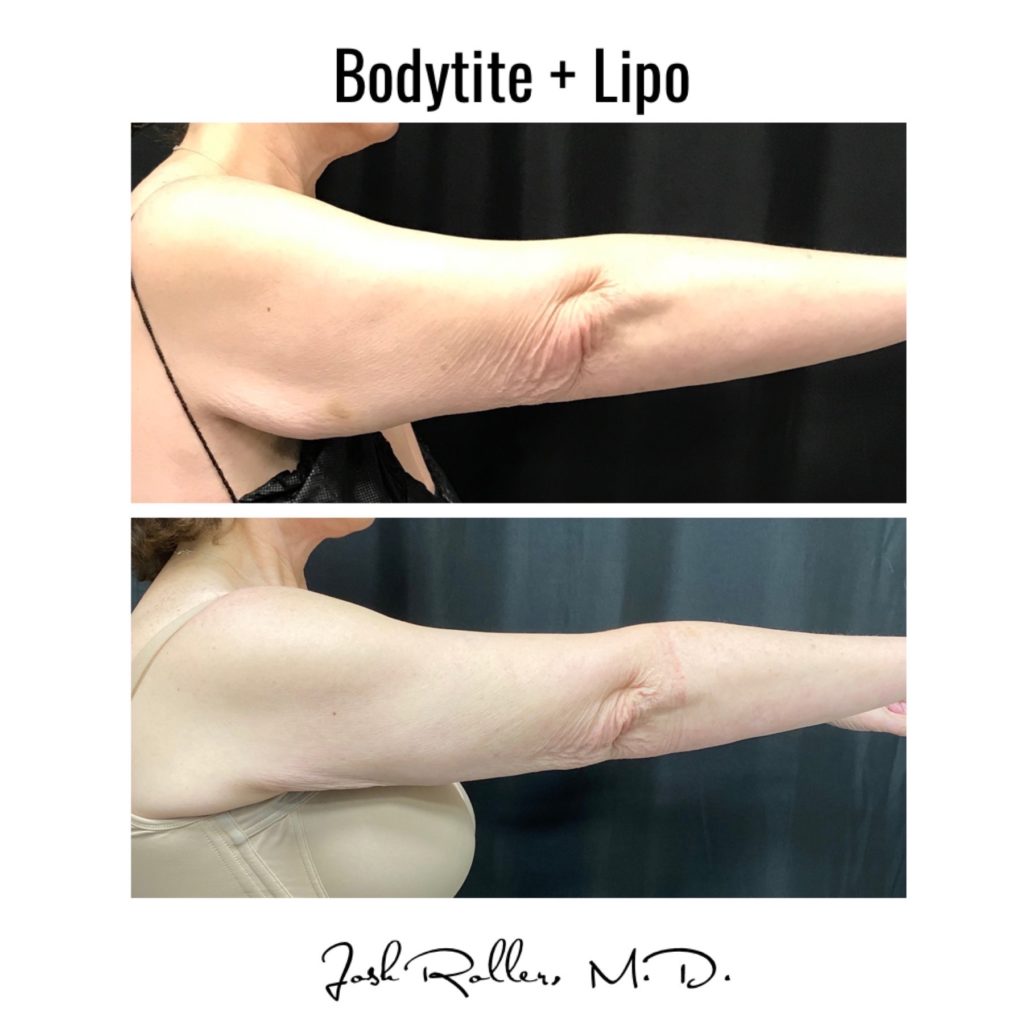 BodyTite Before & After Gallery - Patient 12743 - Image 3