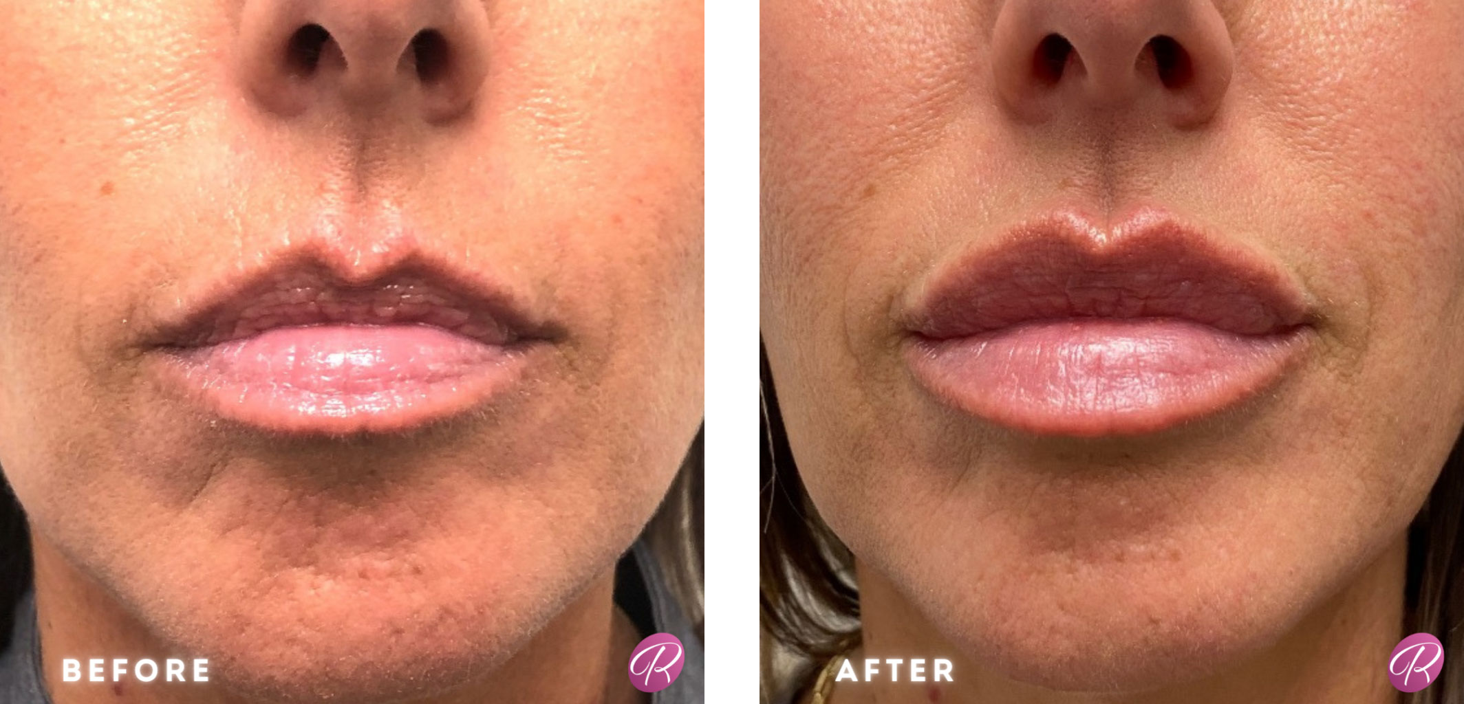 Juvederm Before & After Gallery - Patient 12737 - Image 1