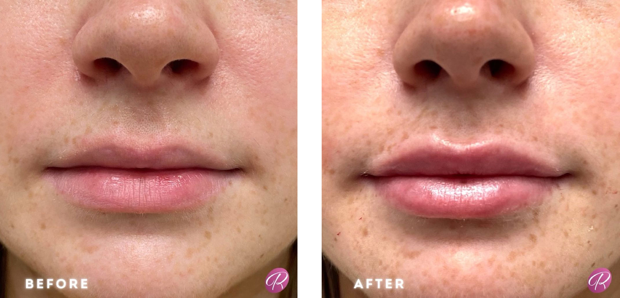Juvederm Before & After Gallery - Patient 12735 - Image 1