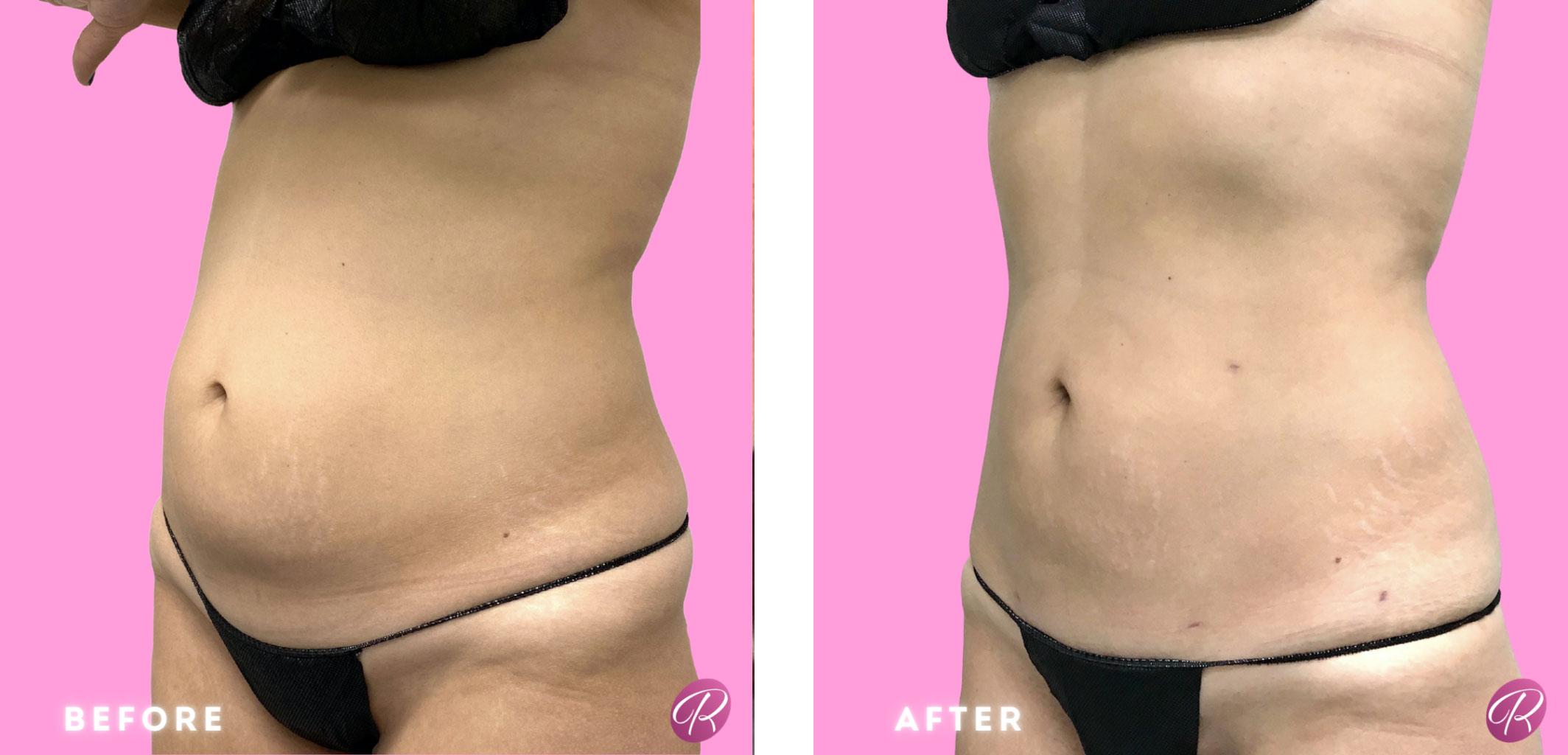 BodyTite Before & After Gallery - Patient 12832 - Image 1