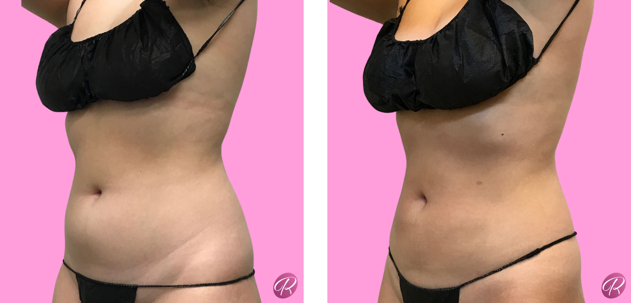 BodyTite Before & After Gallery - Patient 12828 - Image 1