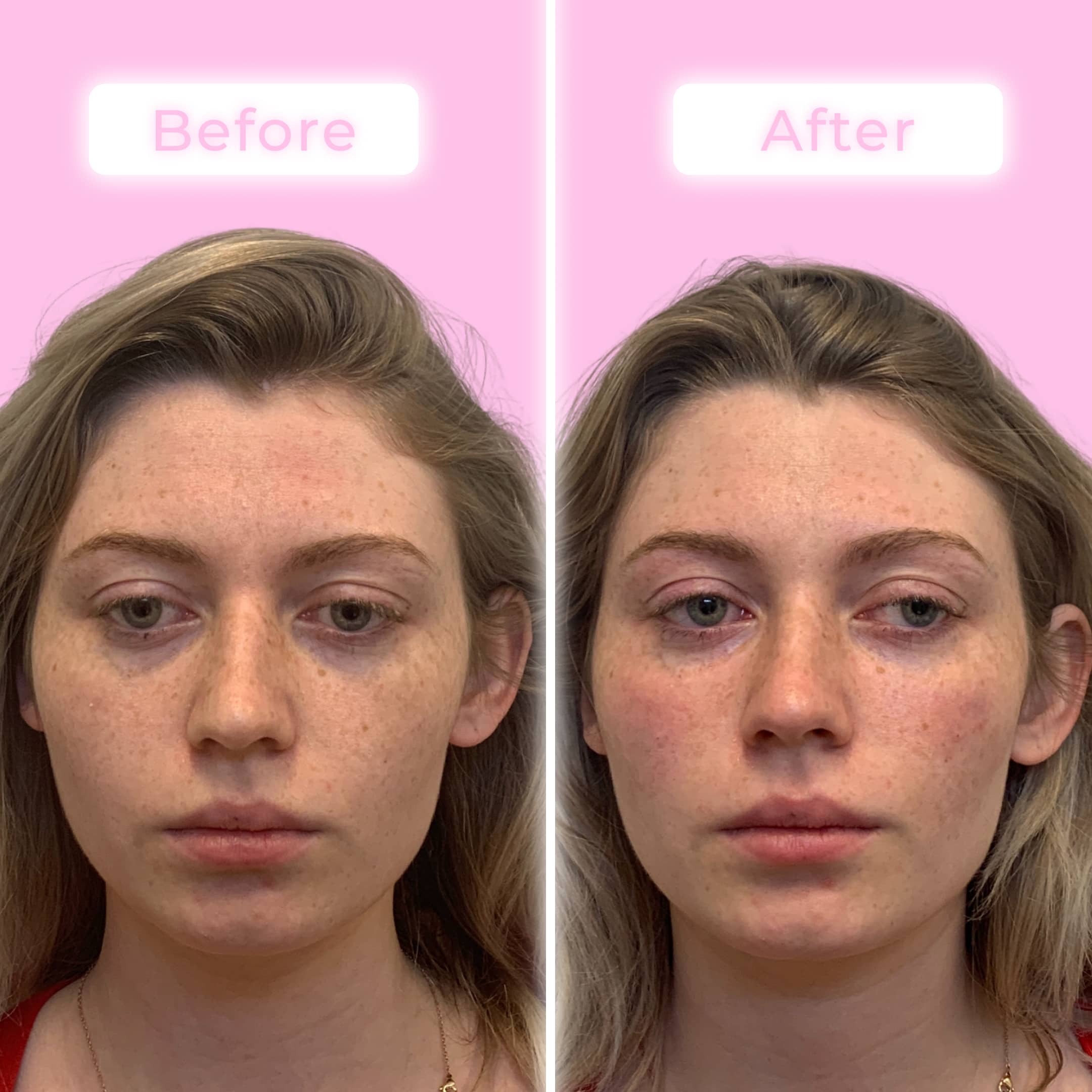 Fillers Before & After Gallery - Patient 12512 - Image 1