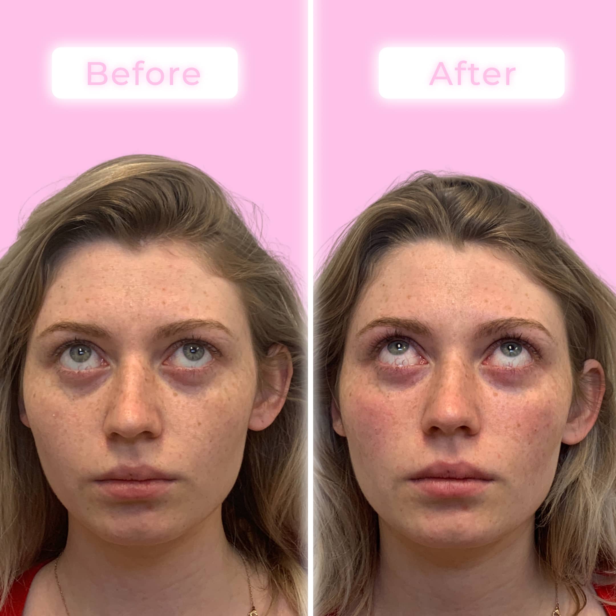 Fillers Before & After Gallery - Patient 12512 - Image 2