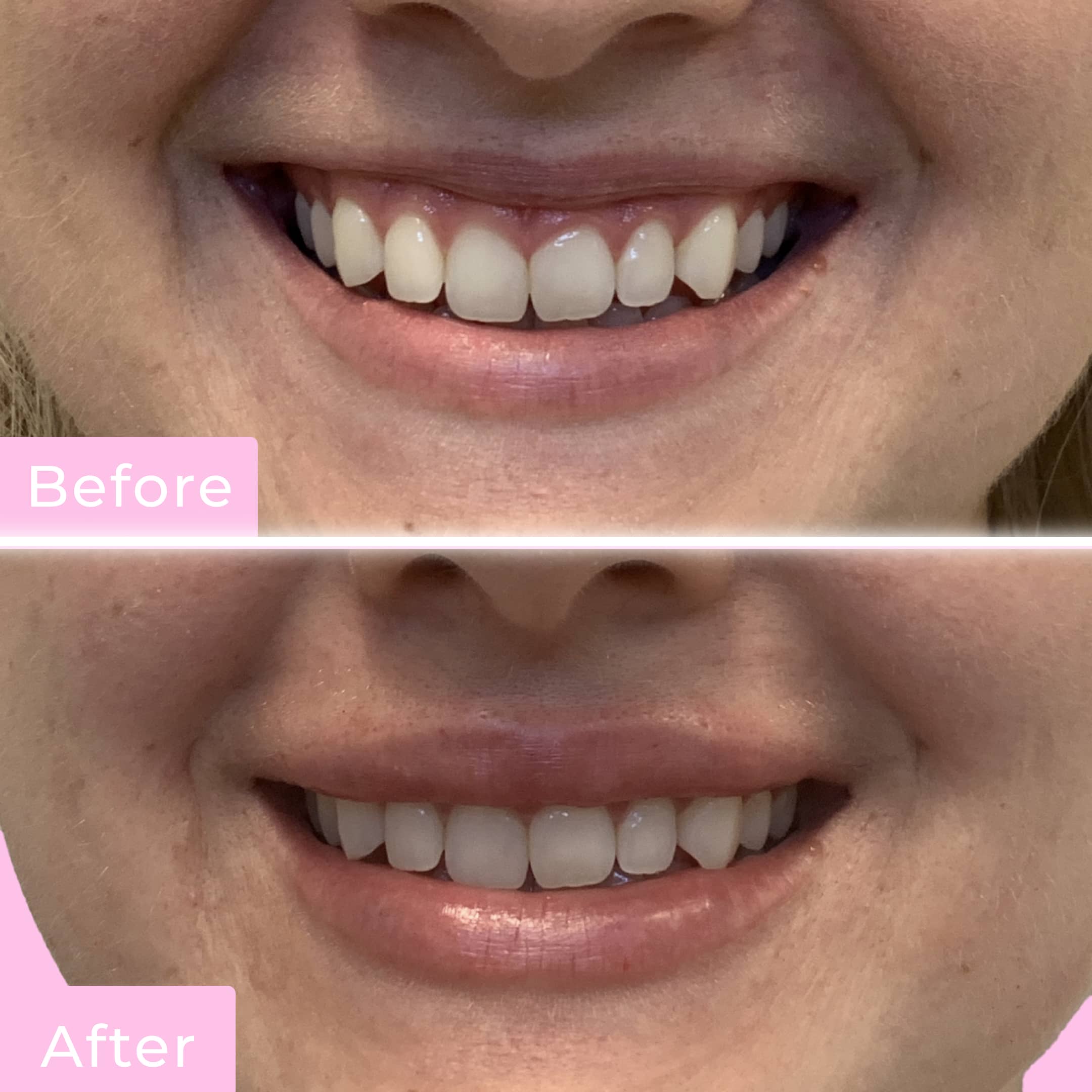 Lip Flip Before & After Gallery - Patient 12678 - Image 2