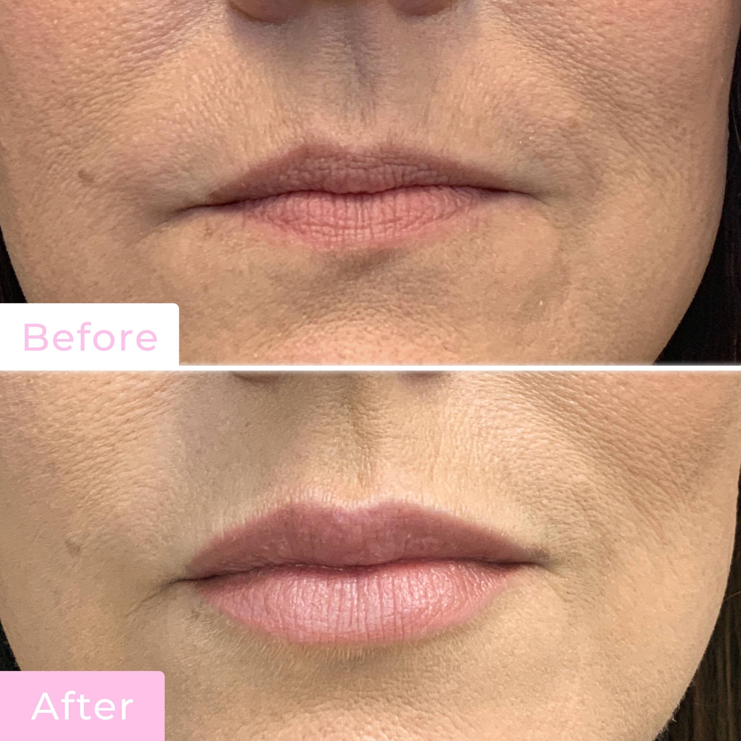 Fillers Before & After Gallery - Patient 12489 - Image 1