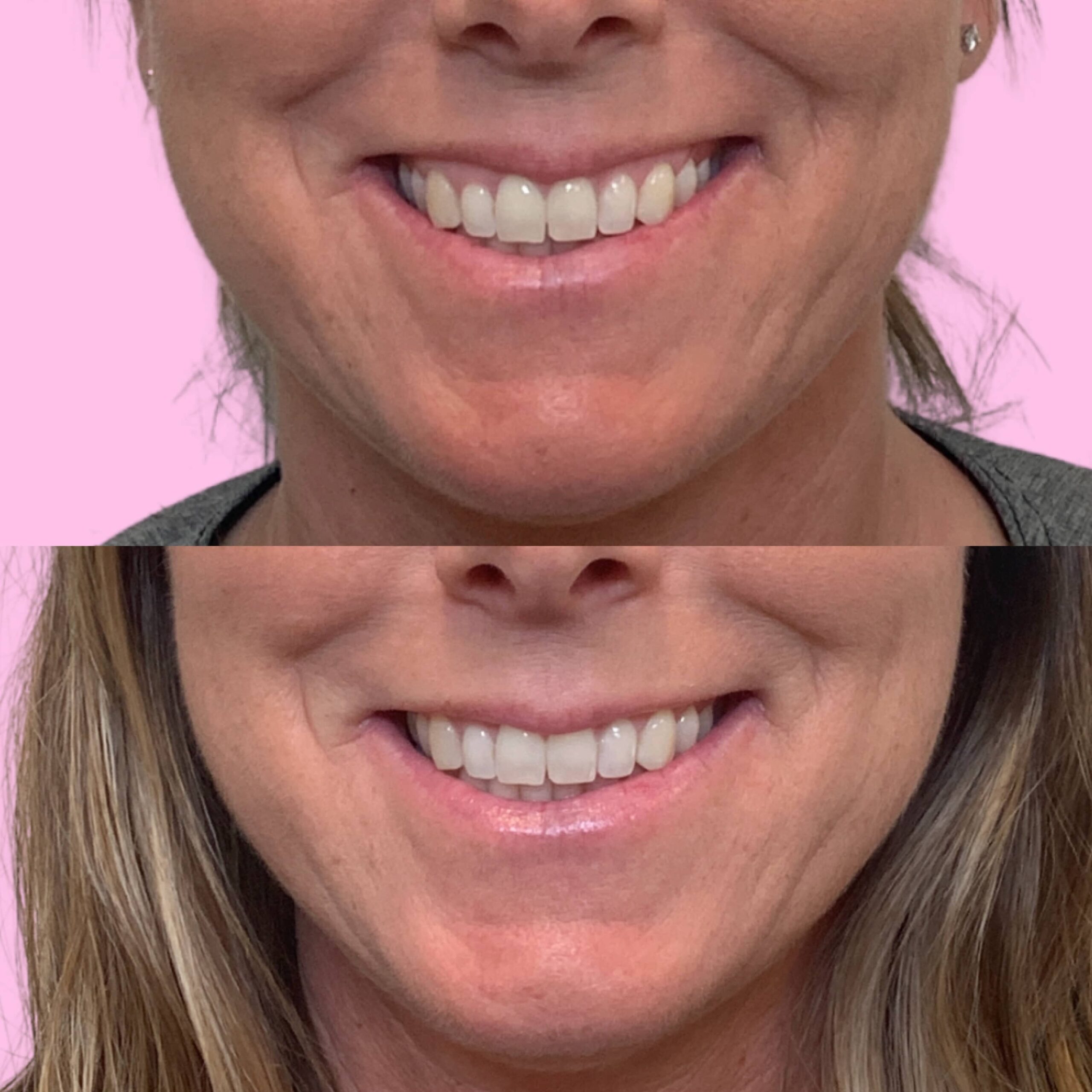 Lip Flip Before & After Gallery - Patient 12671 - Image 1