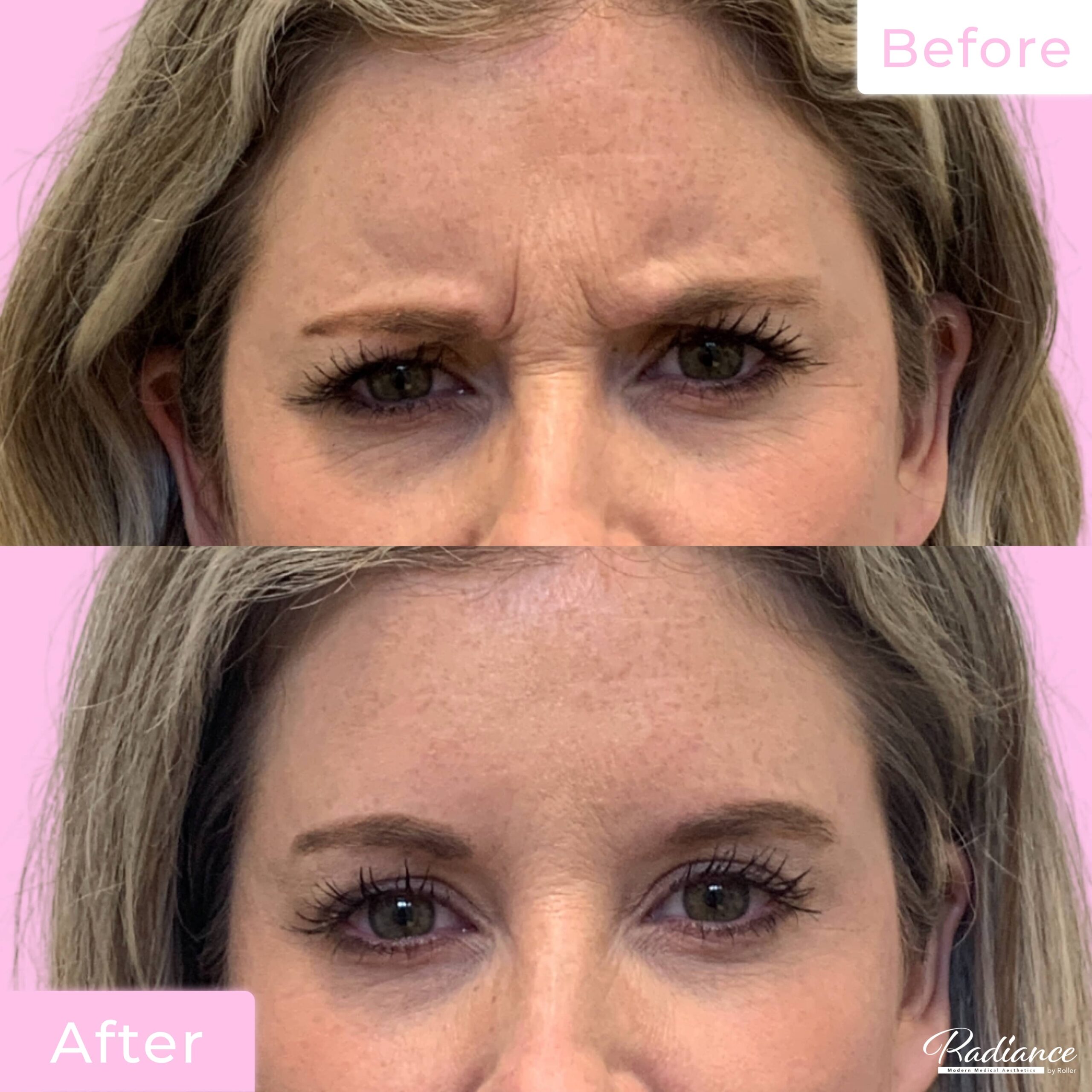 Jeuveau Before & After Gallery - Patient 12728 - Image 2