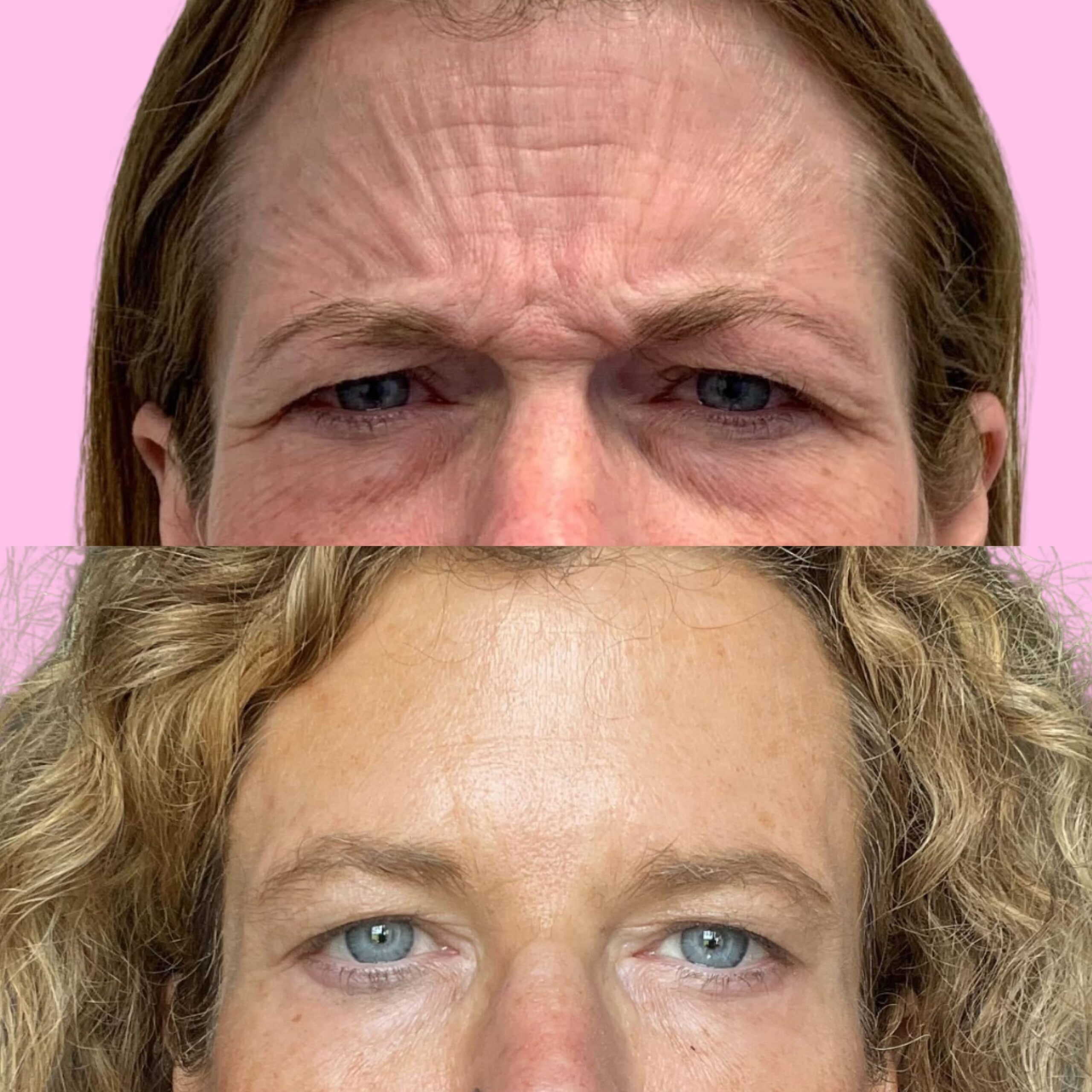 Jeuveau Before & After Gallery - Patient 12726 - Image 2