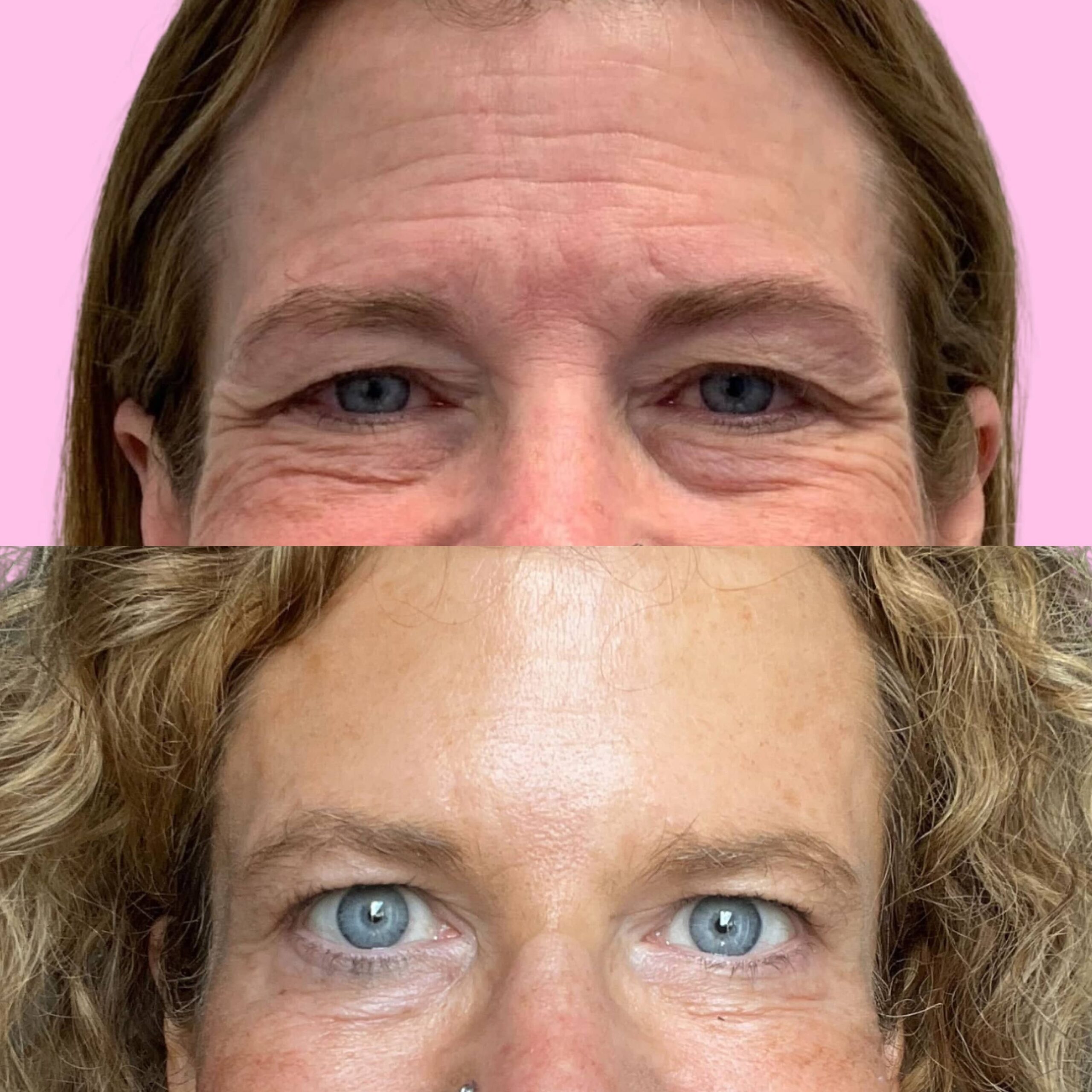 Jeuveau Before & After Gallery - Patient 12726 - Image 3