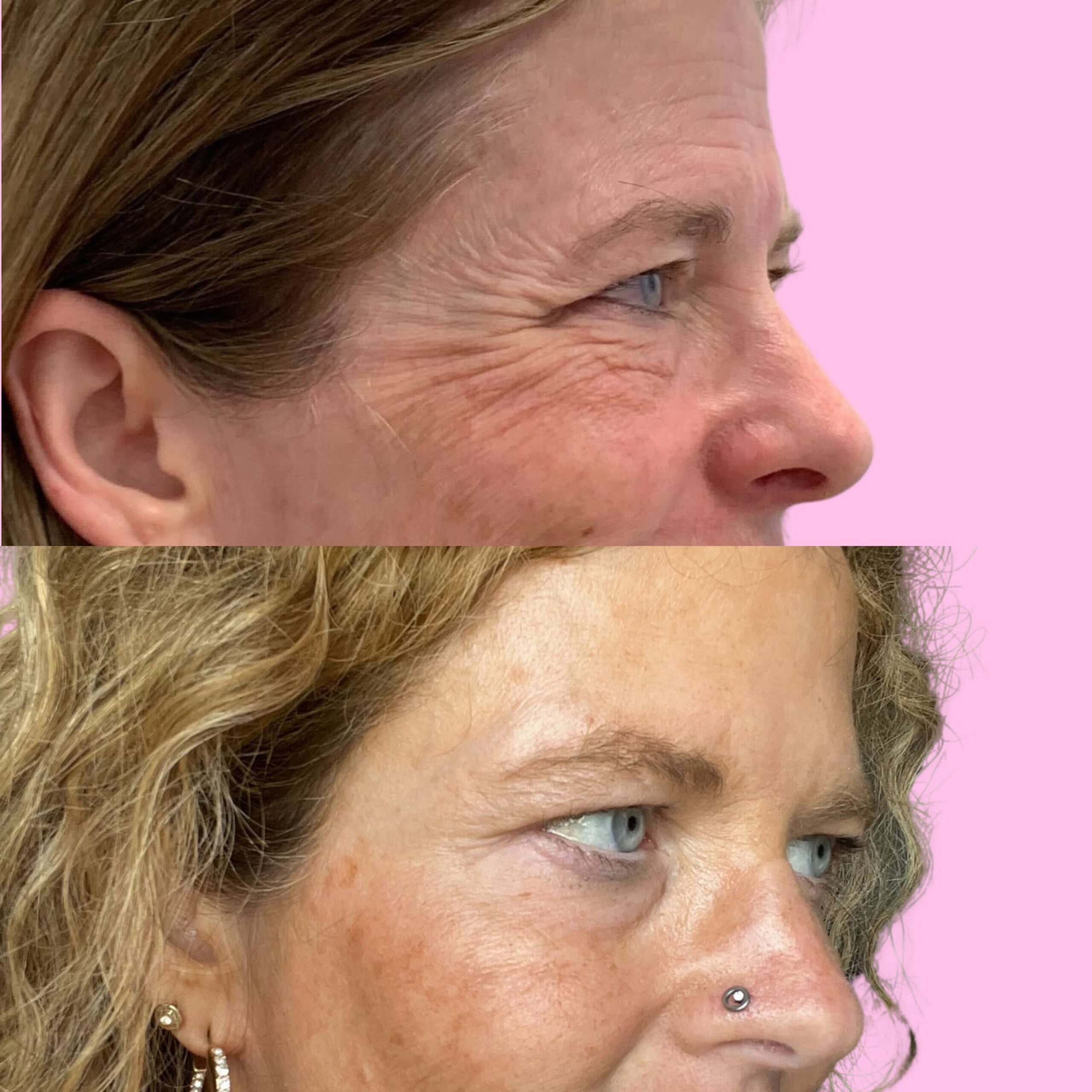 Jeuveau Before & After Gallery - Patient 12726 - Image 4