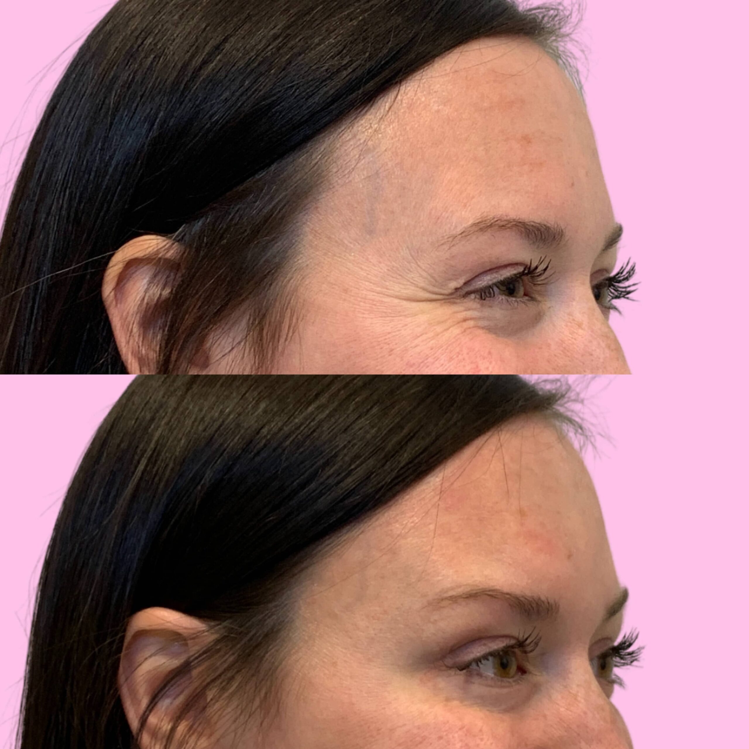 Jeuveau Before & After Gallery - Patient 12724 - Image 3