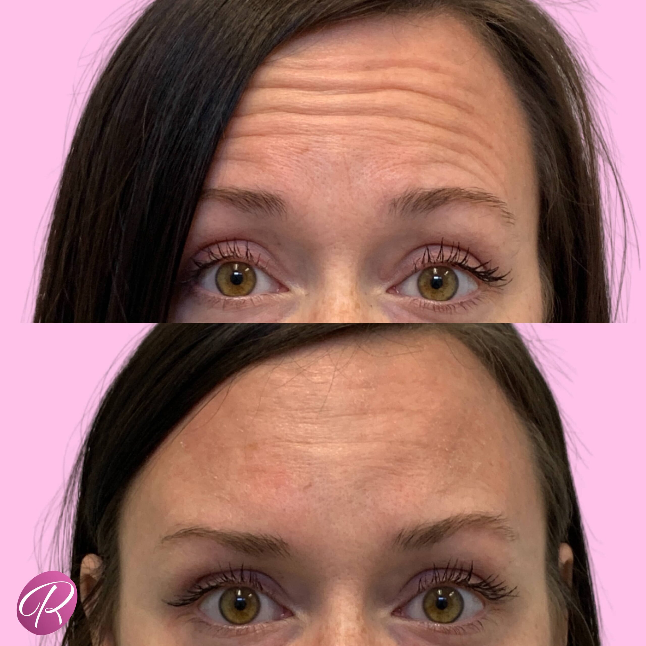 Jeuveau Before & After Gallery - Patient 12724 - Image 2