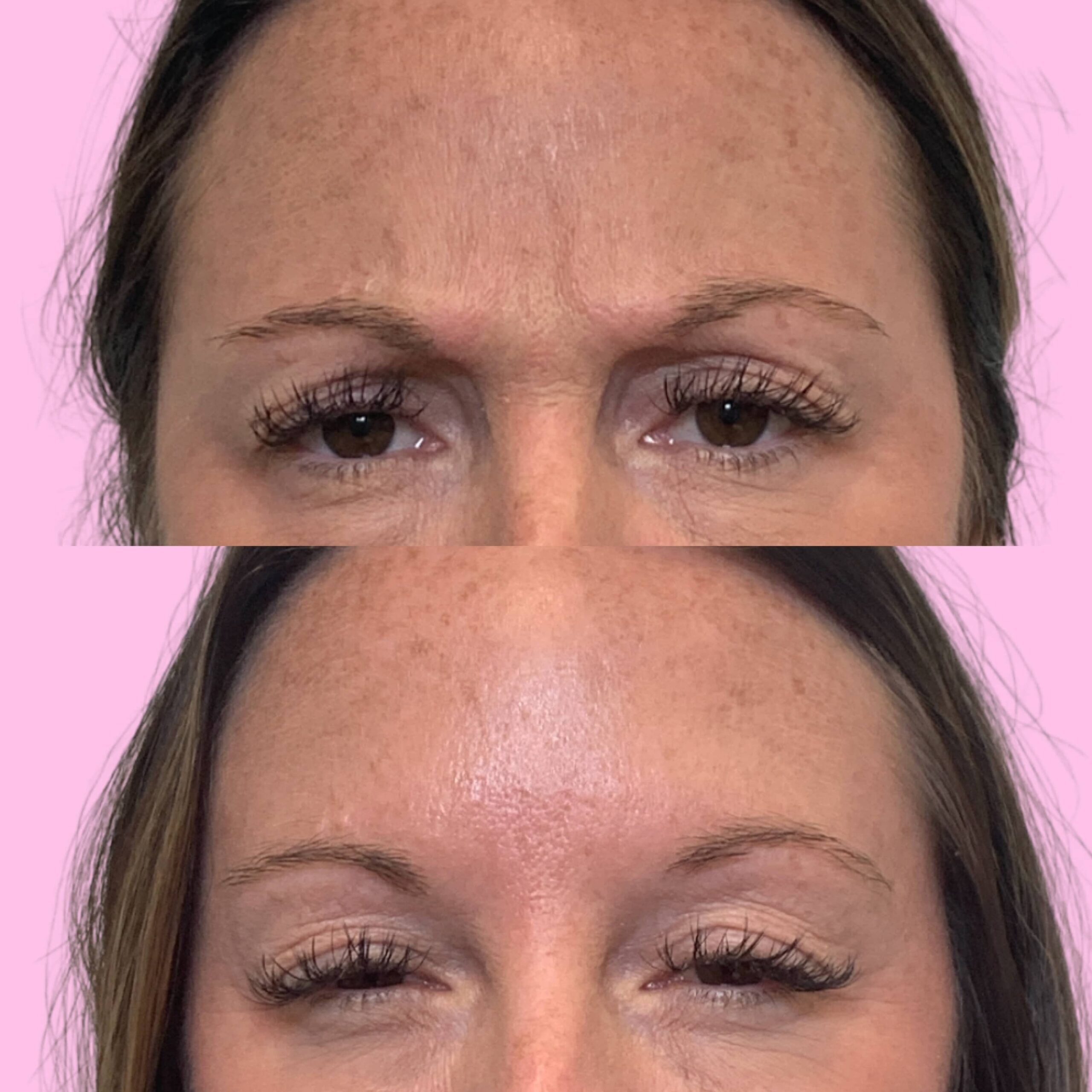 Jeuveau Before & After Gallery - Patient 12722 - Image 2