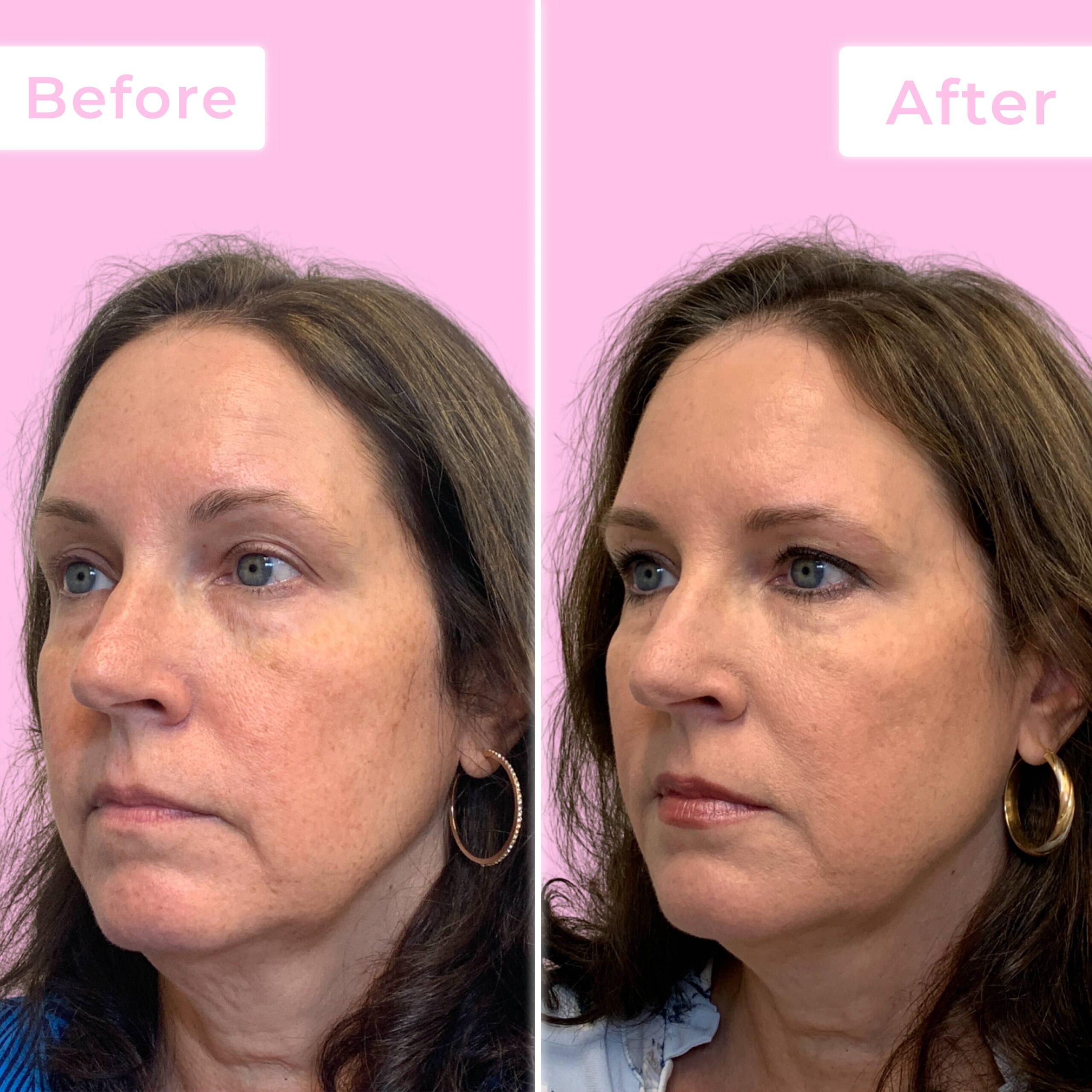 Jeuveau Before & After Gallery - Patient 12721 - Image 1