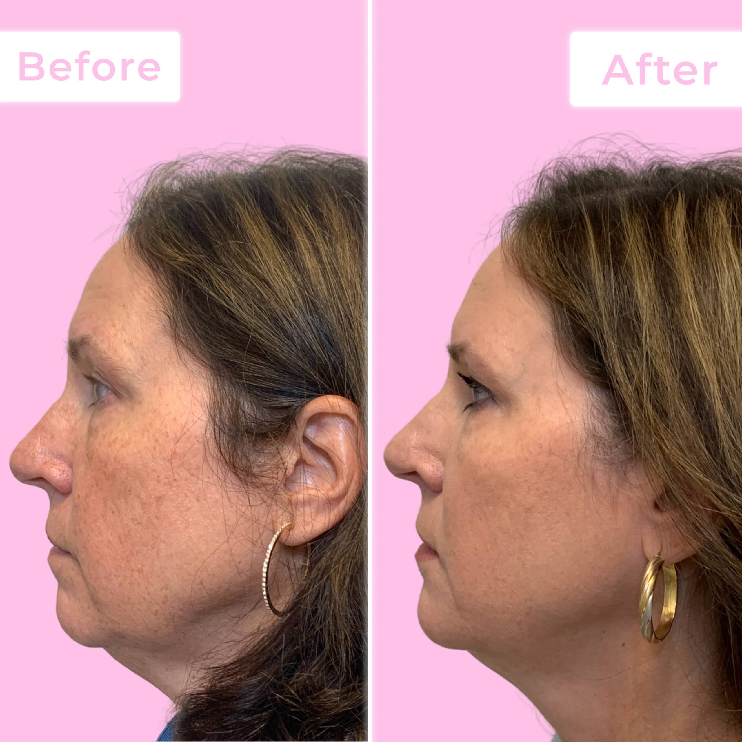 Jeuveau Before & After Gallery - Patient 12721 - Image 2