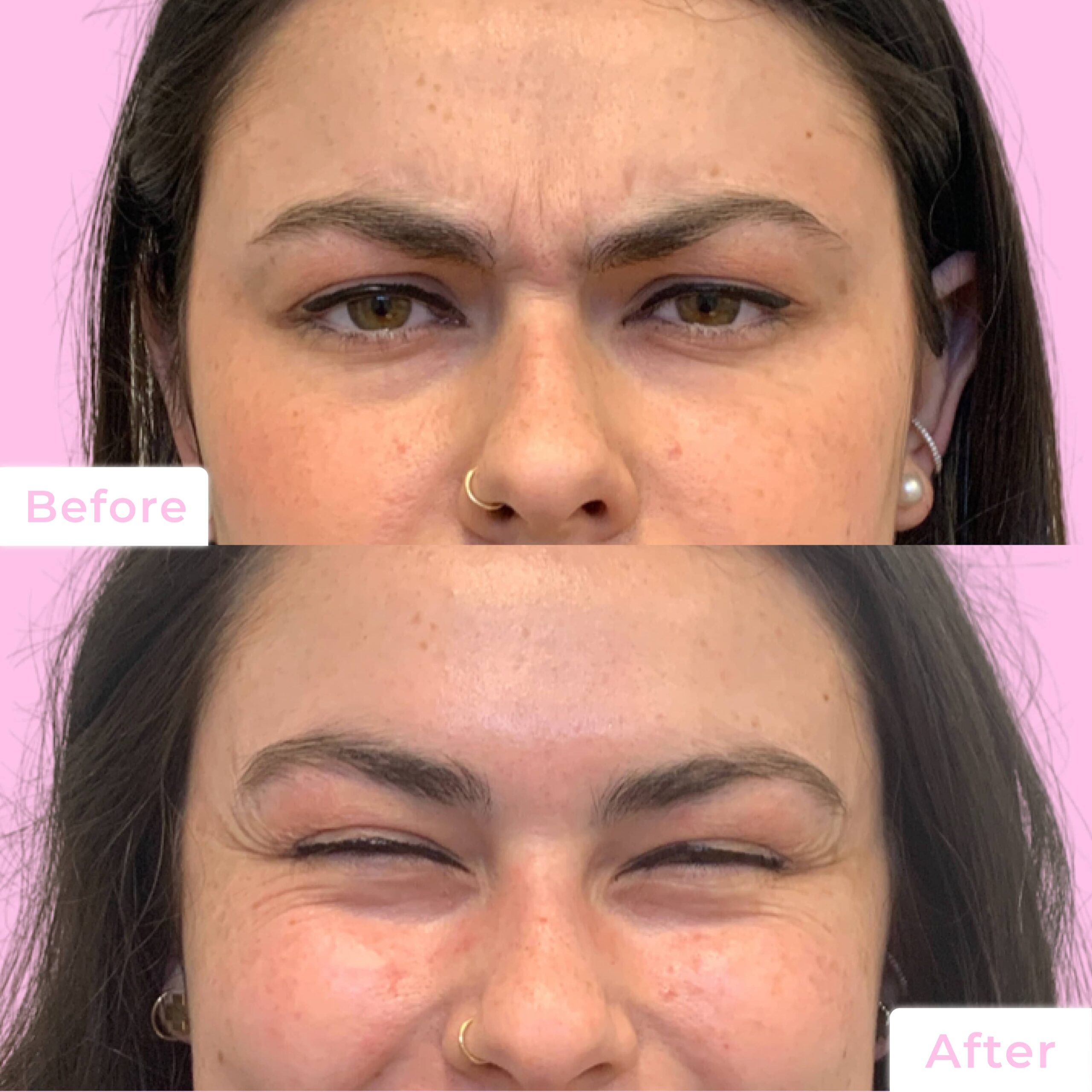 Jeuveau Before & After Gallery - Patient 12714 - Image 1