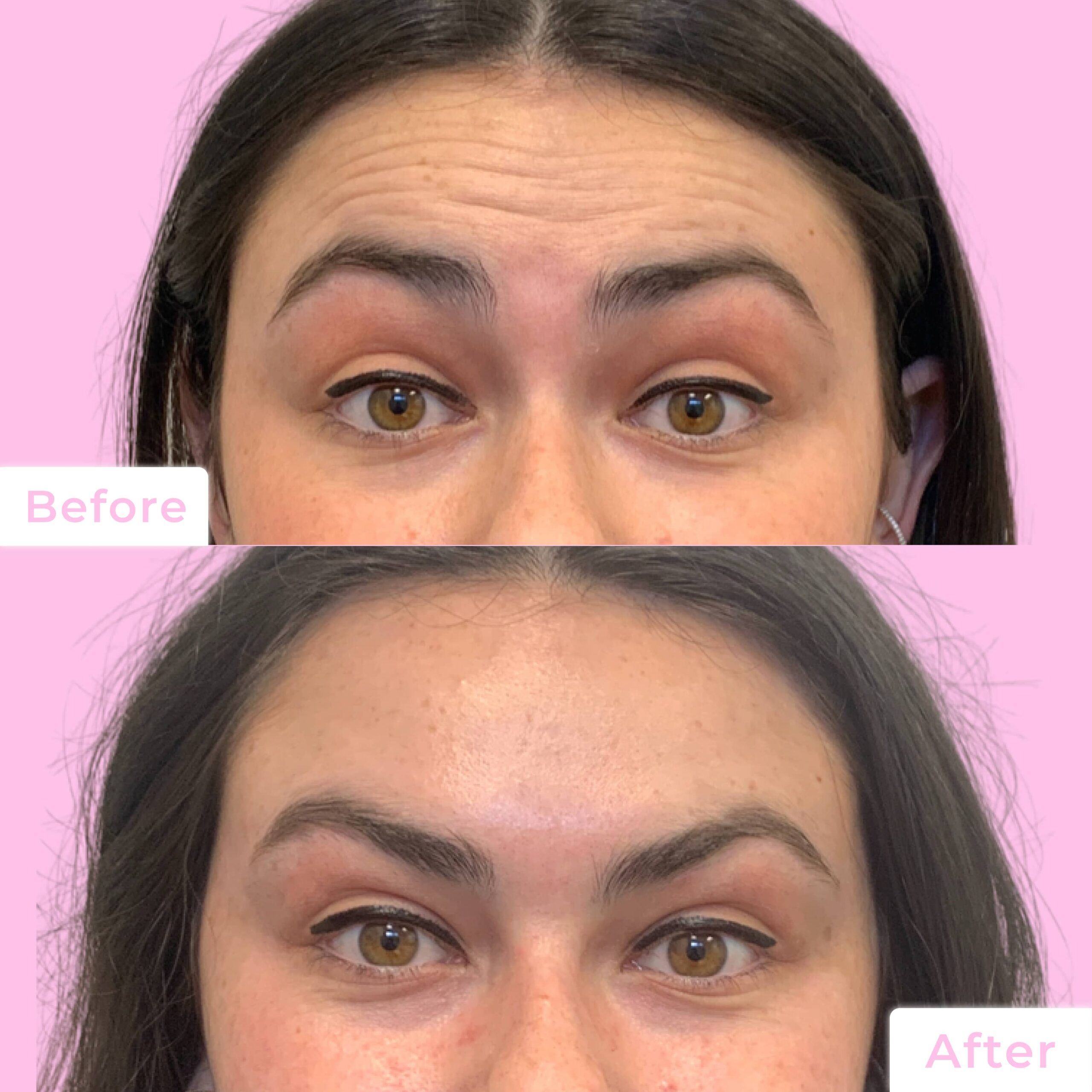 Jeuveau Before & After Gallery - Patient 12714 - Image 2