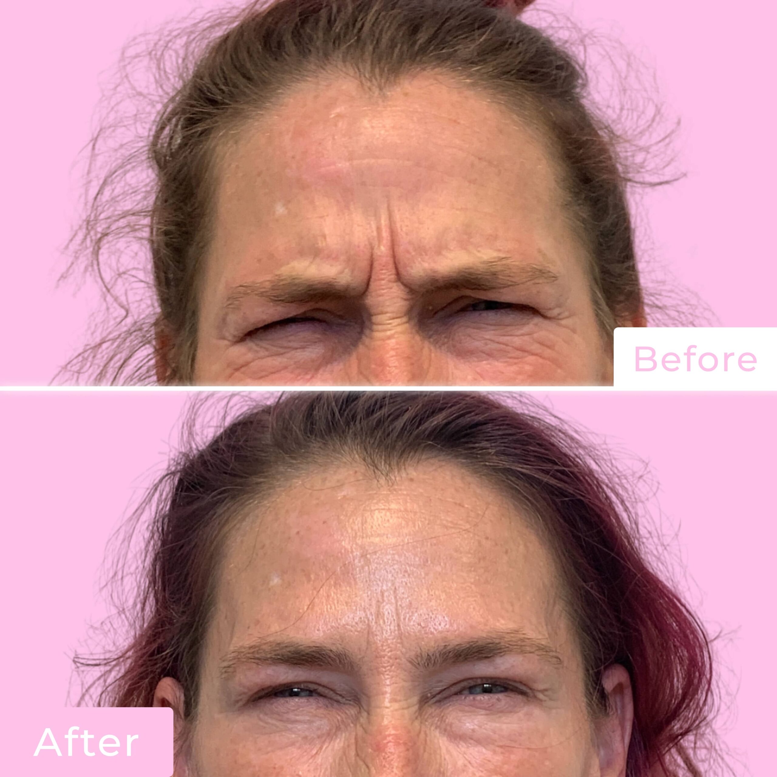 Jeuveau Before & After Gallery - Patient 12713 - Image 1