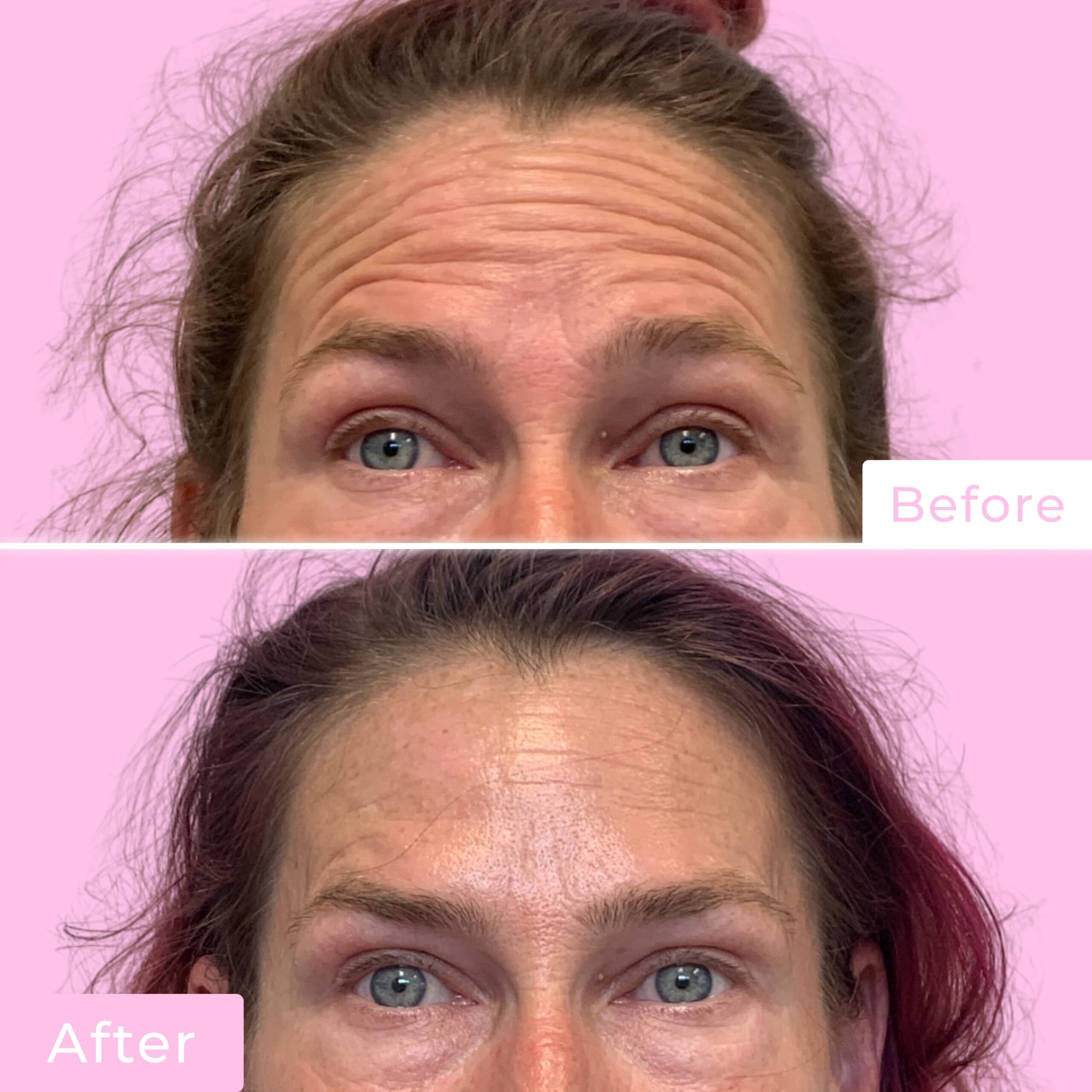 Jeuveau Before & After Gallery - Patient 12713 - Image 2
