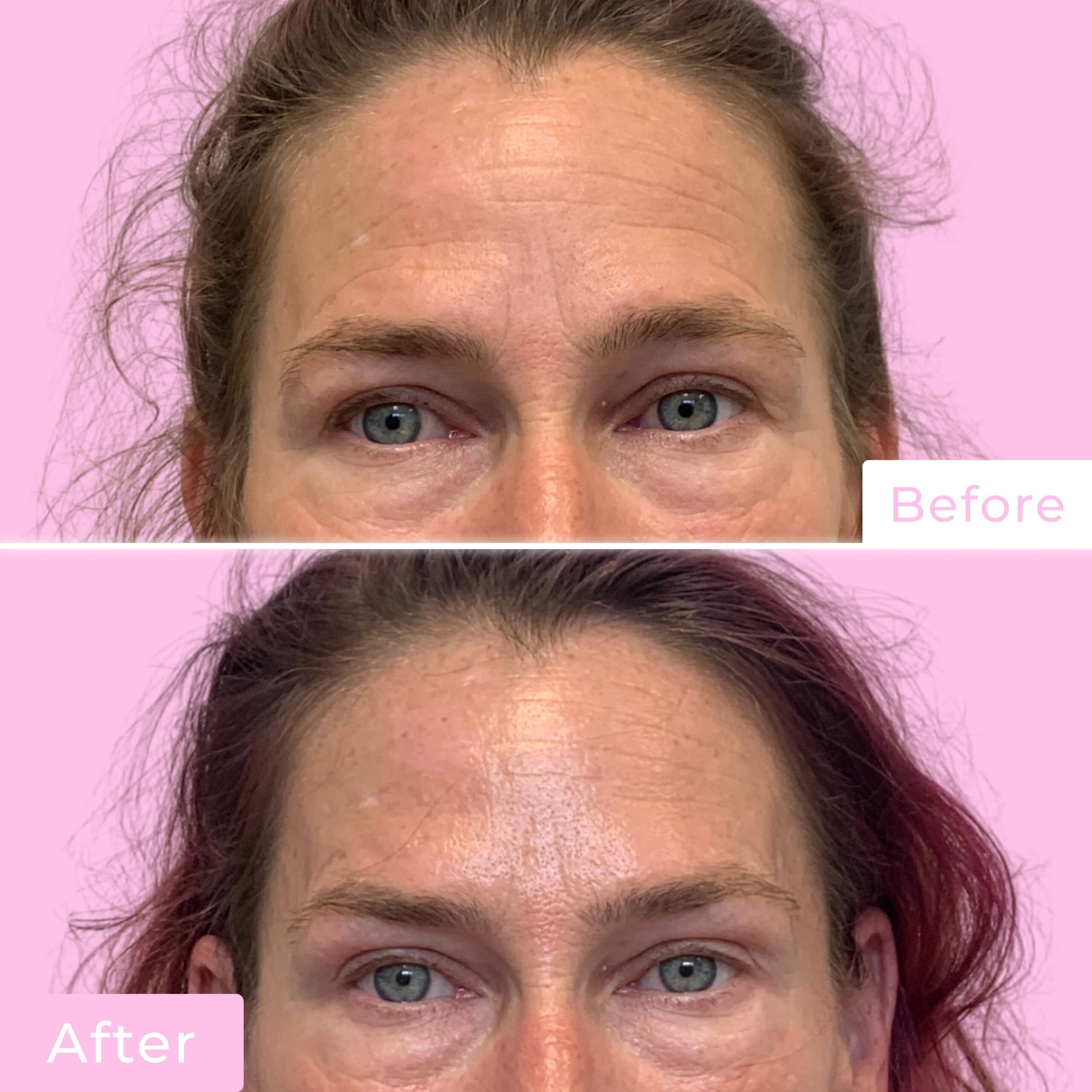 Jeuveau Before & After Gallery - Patient 12713 - Image 3