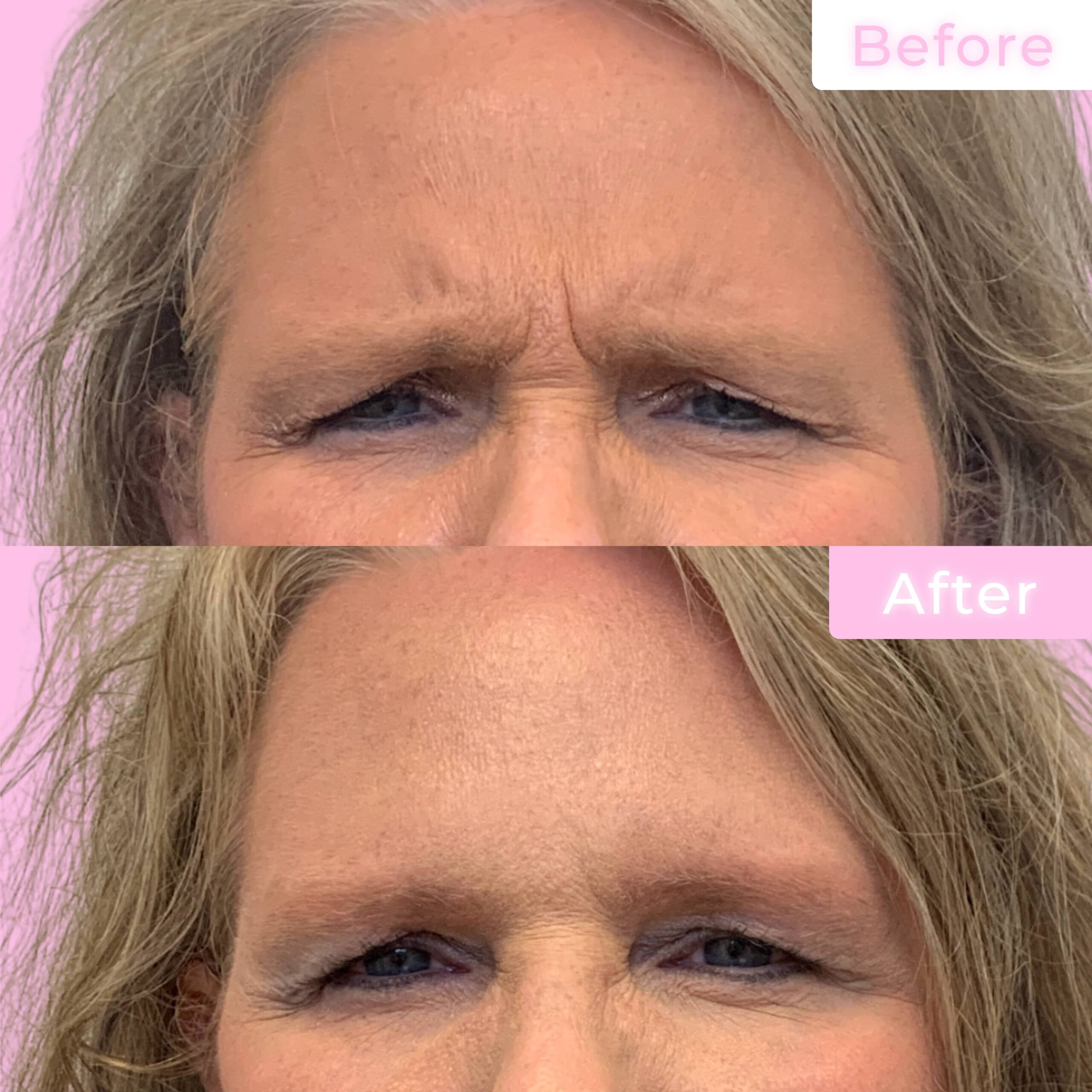 Jeuveau Before & After Gallery - Patient 12708 - Image 1