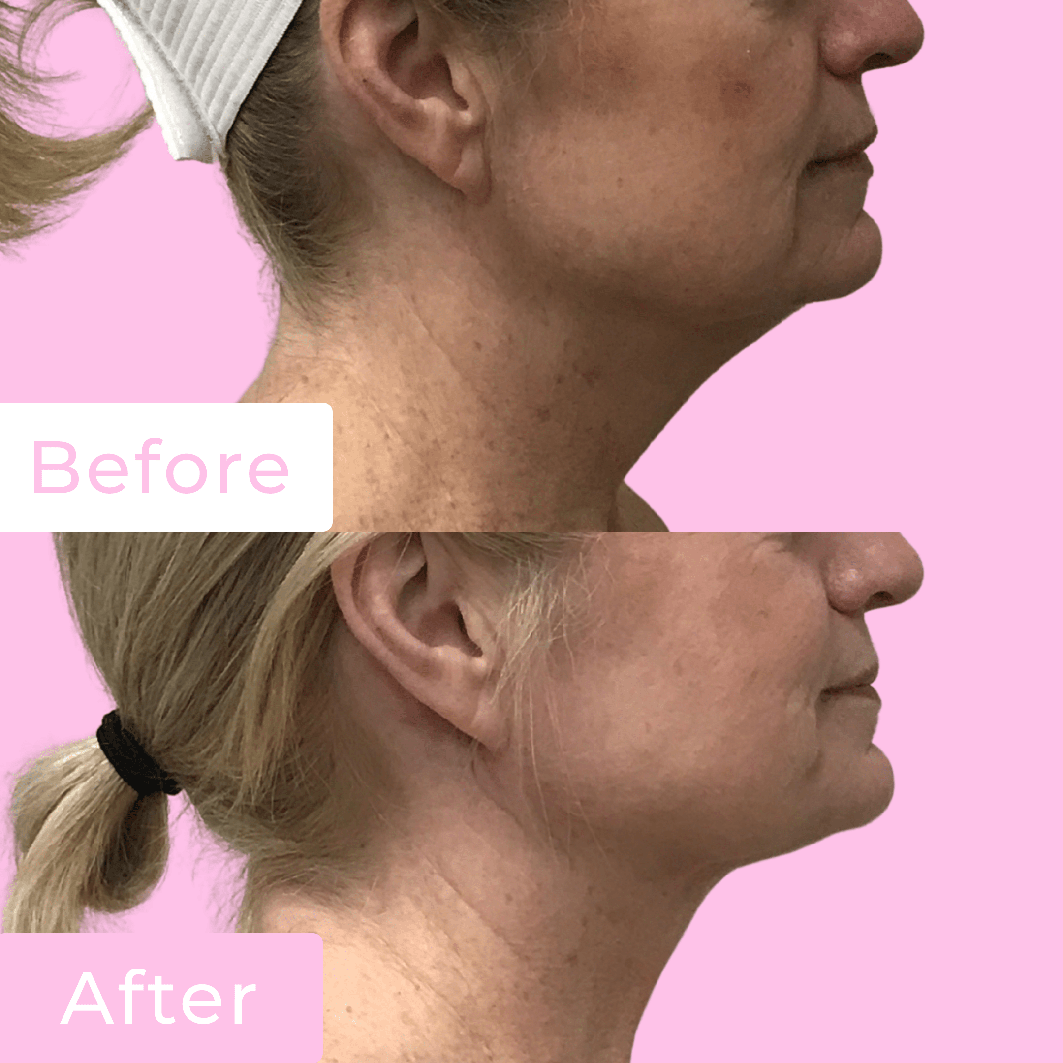FaceTite Before & After Gallery - Patient 13213 - Image 1