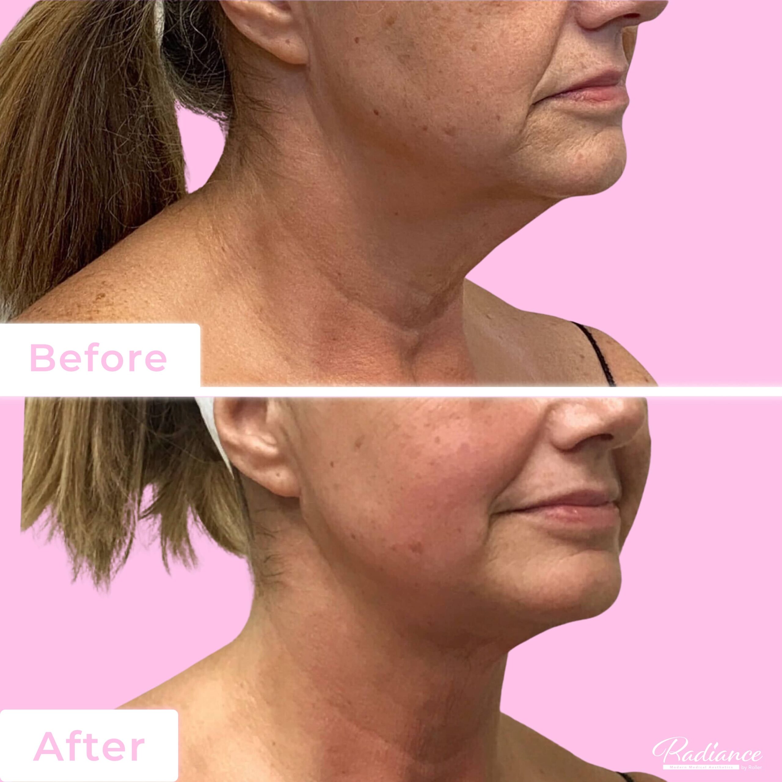FaceTite Before & After Gallery - Patient 13207 - Image 1