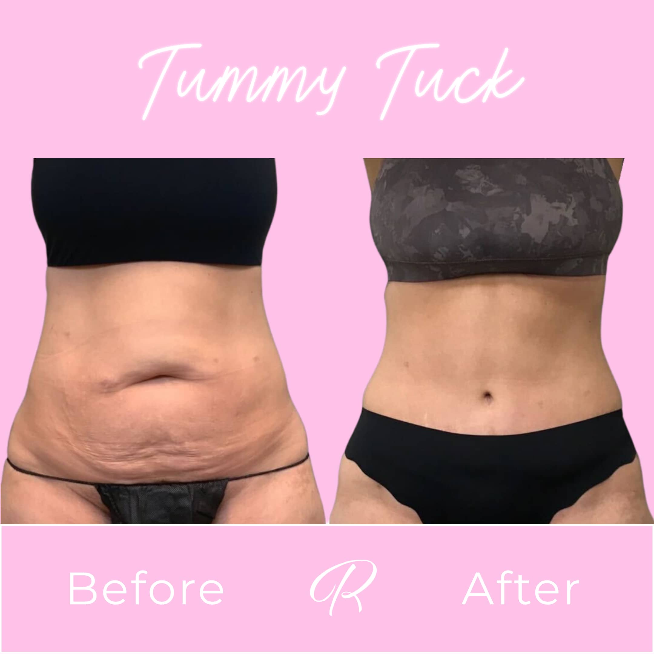 Tummy Tuck Before & After Gallery - Patient 13217 - Image 1