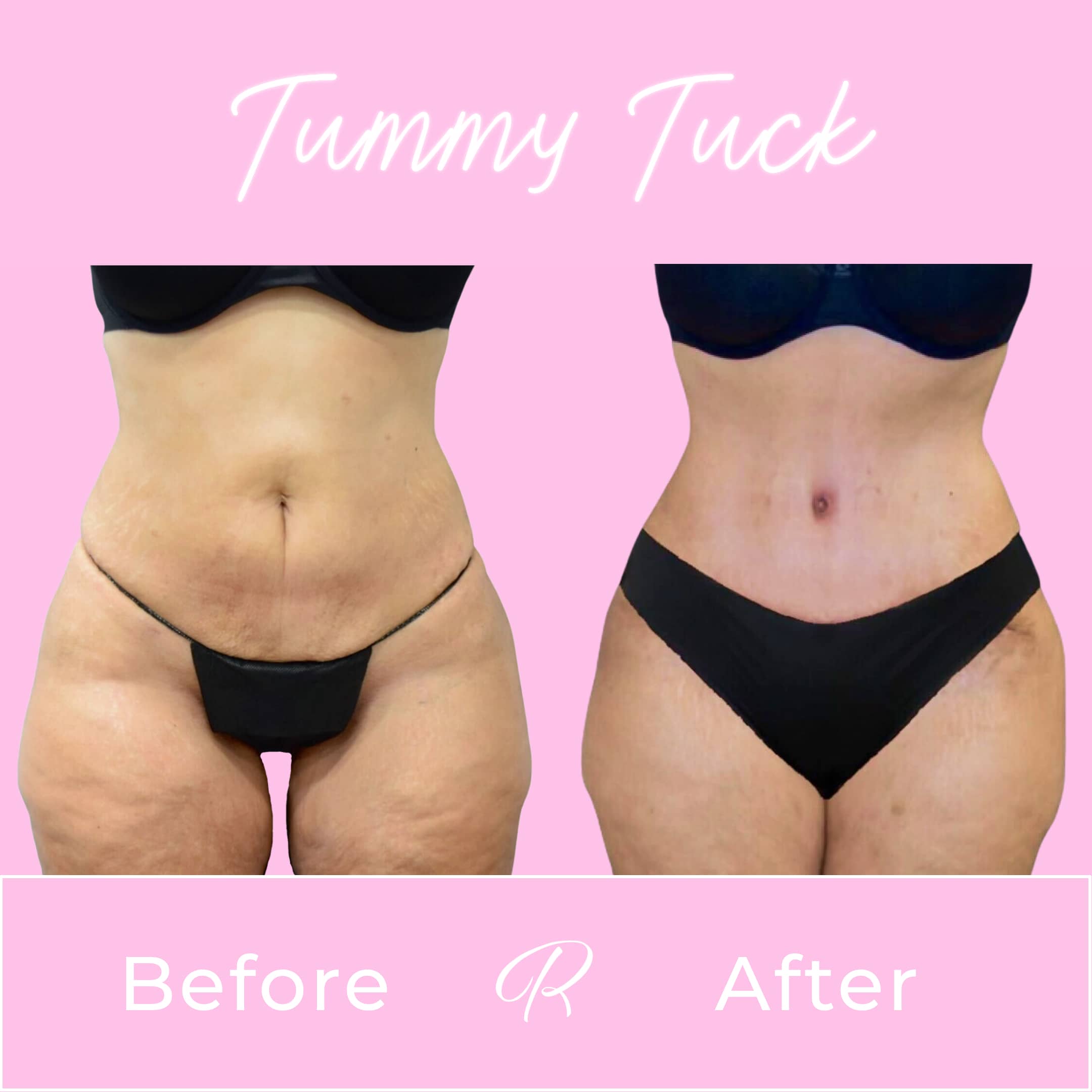 Tummy Tuck Before & After Gallery - Patient 13257 - Image 1