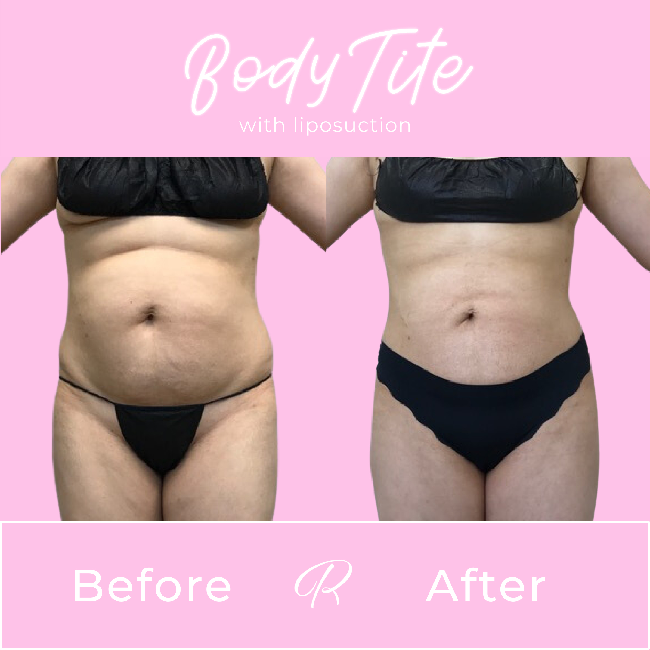 BodyTite Before & After Gallery - Patient 13435 - Image 1