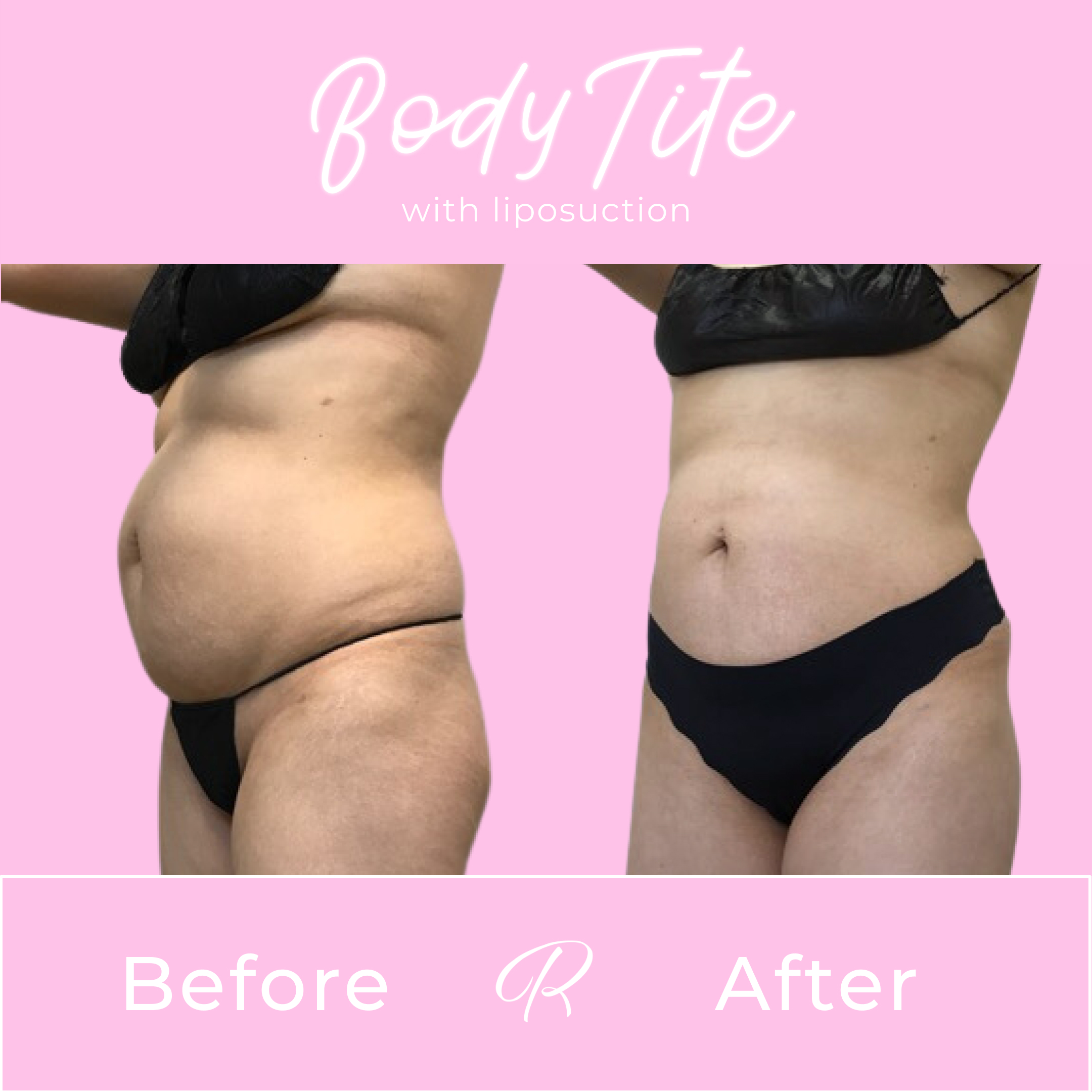 BodyTite Before & After Gallery - Patient 13435 - Image 4