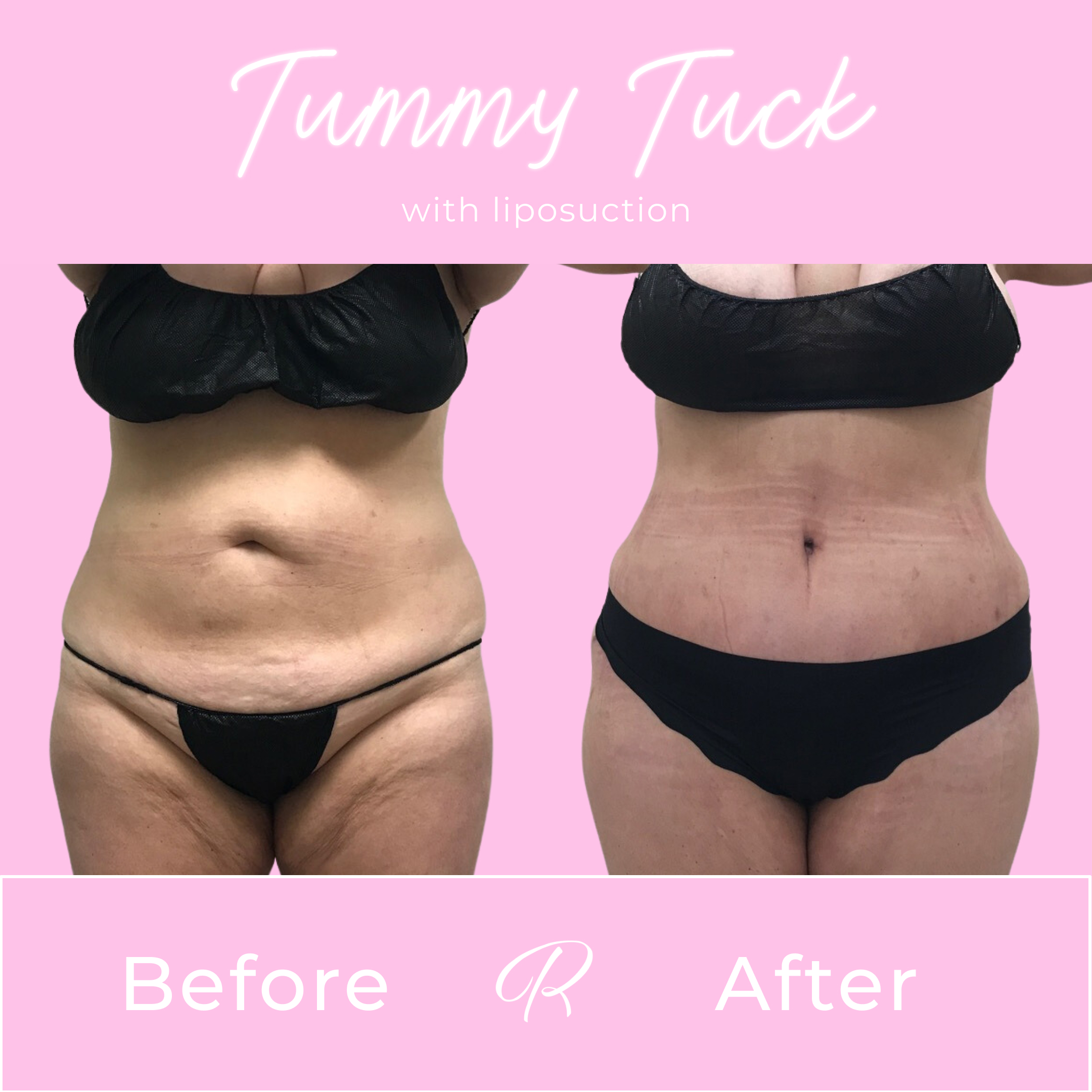 Tummy Tuck Before & After Gallery - Patient 13260 - Image 1